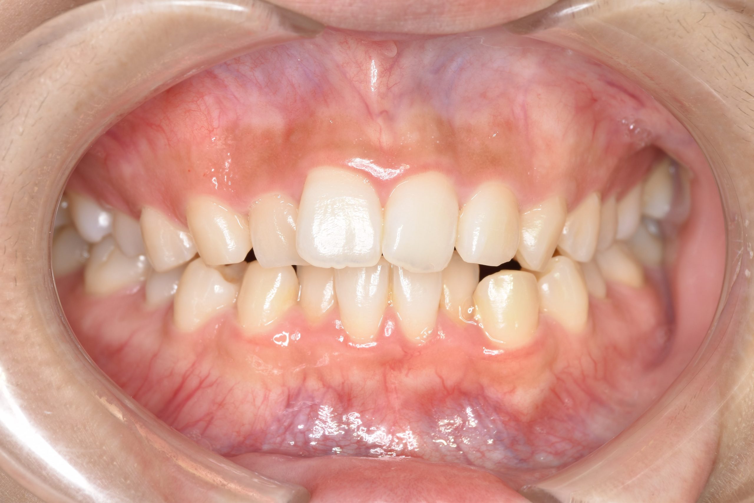 全顎ワイヤー矯正　症例_315