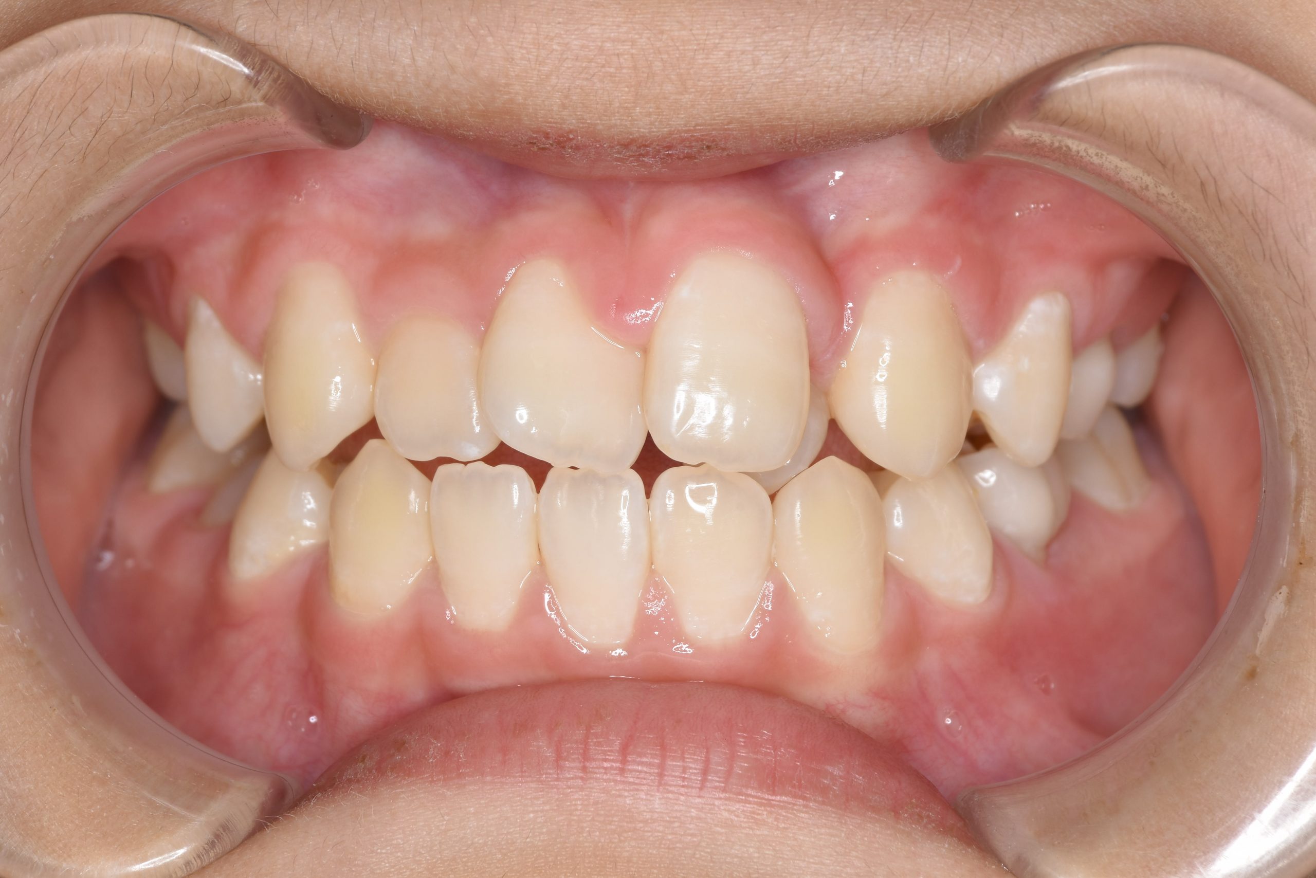 全顎ワイヤー矯正　症例_323