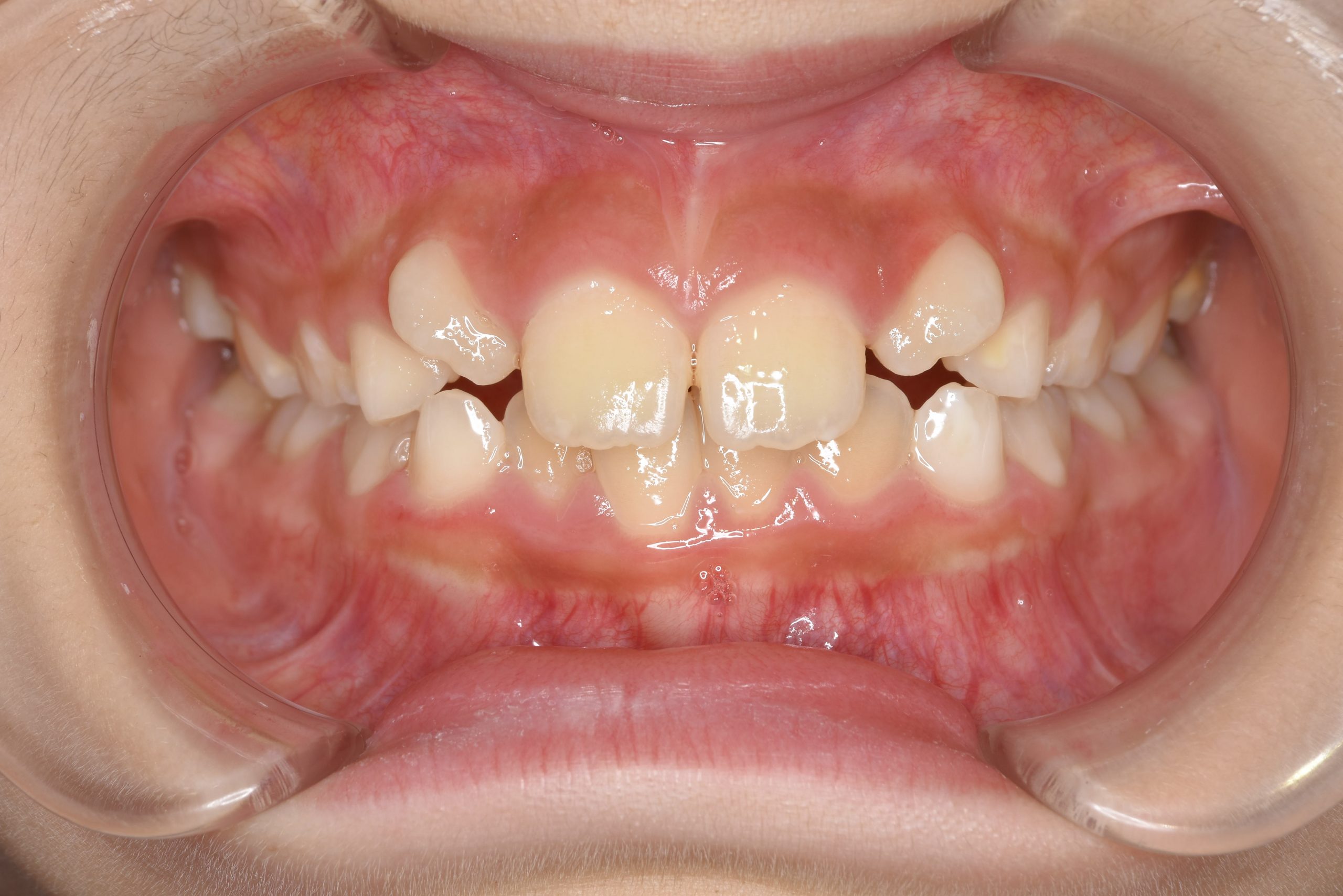 全顎ワイヤー矯正　症例_347