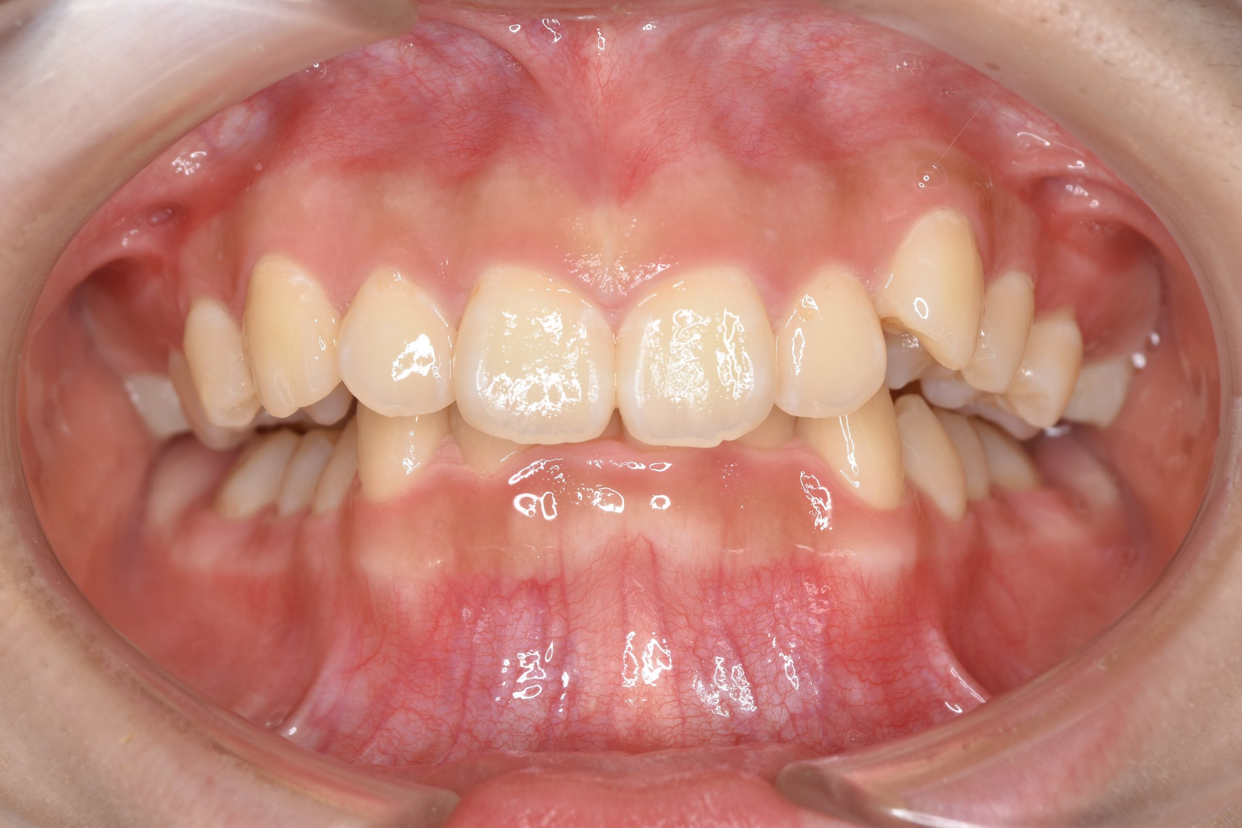 全顎ワイヤー矯正　症例_349