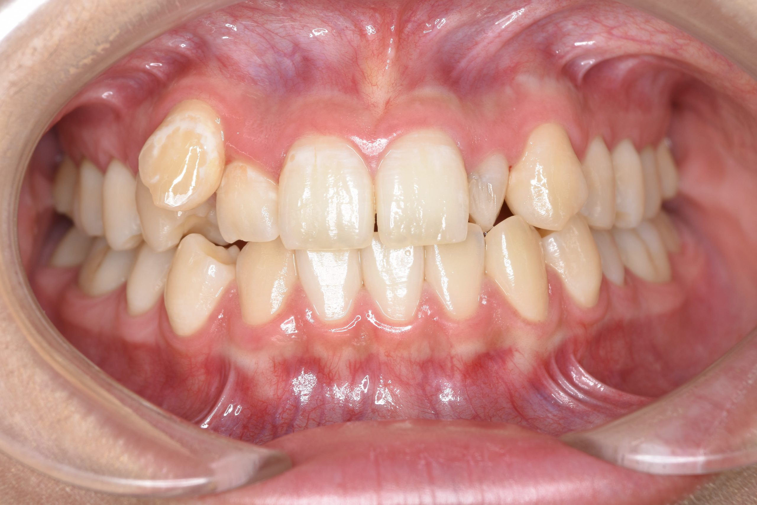 全顎ワイヤー矯正　症例_401