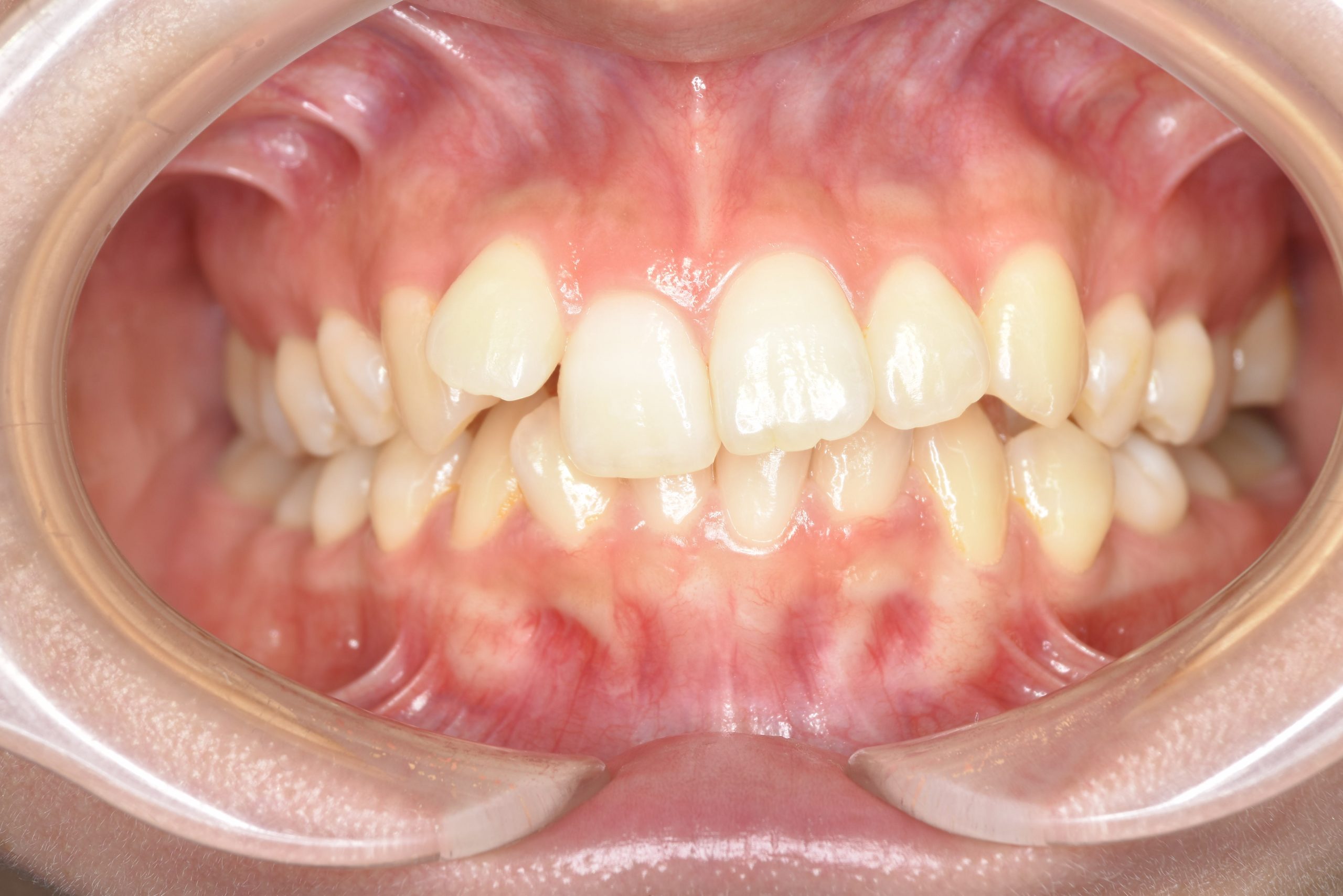 全顎ワイヤー矯正　症例_418