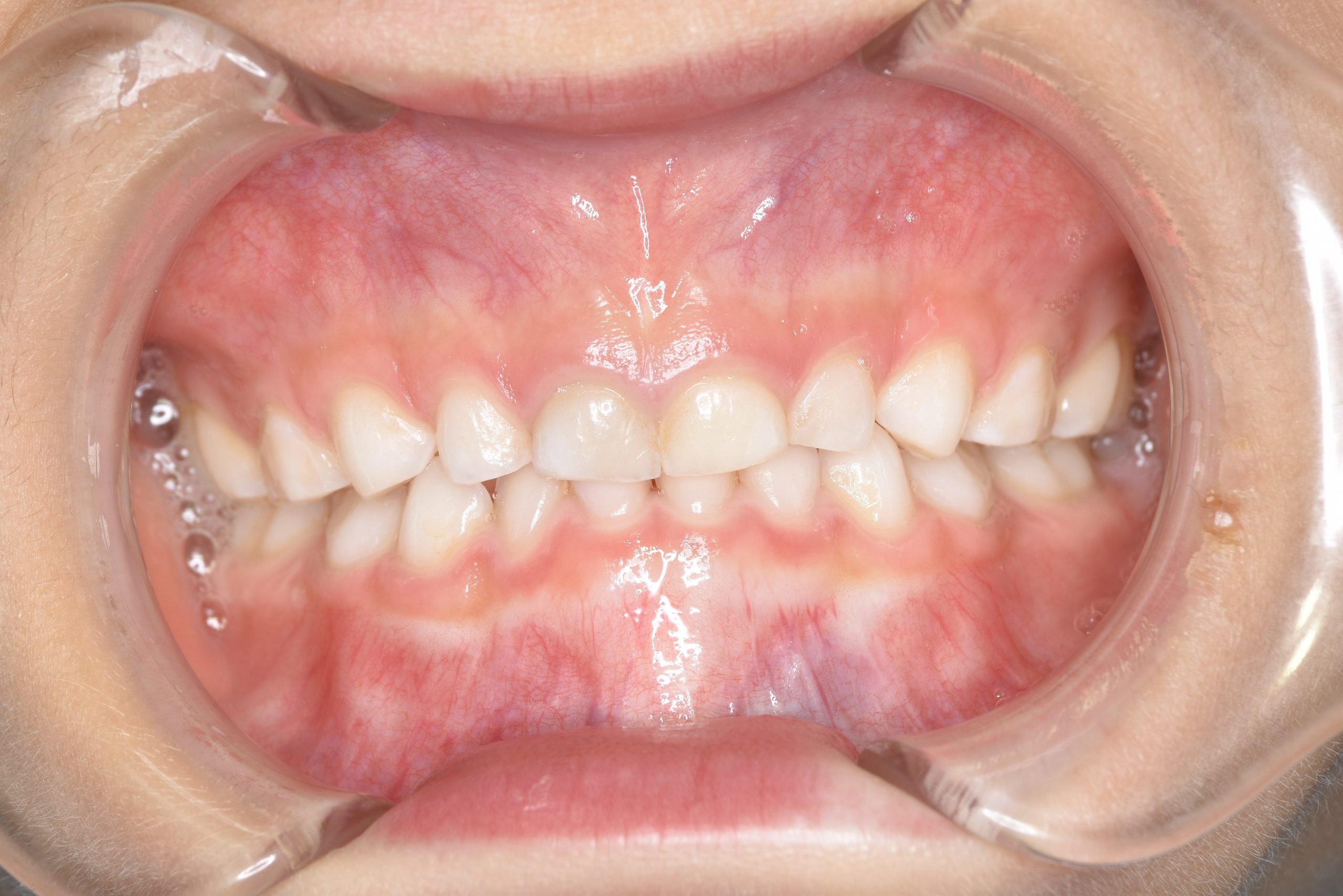 全顎ワイヤー矯正　症例_121