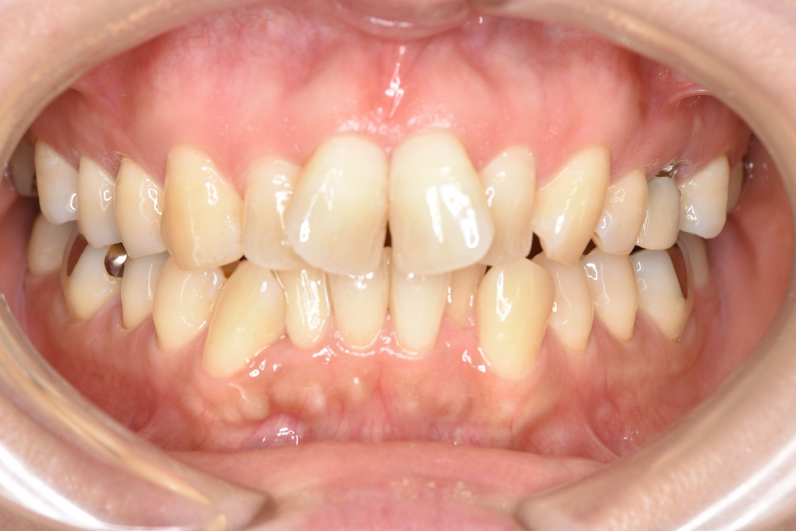 全顎ワイヤー矯正　症例_479