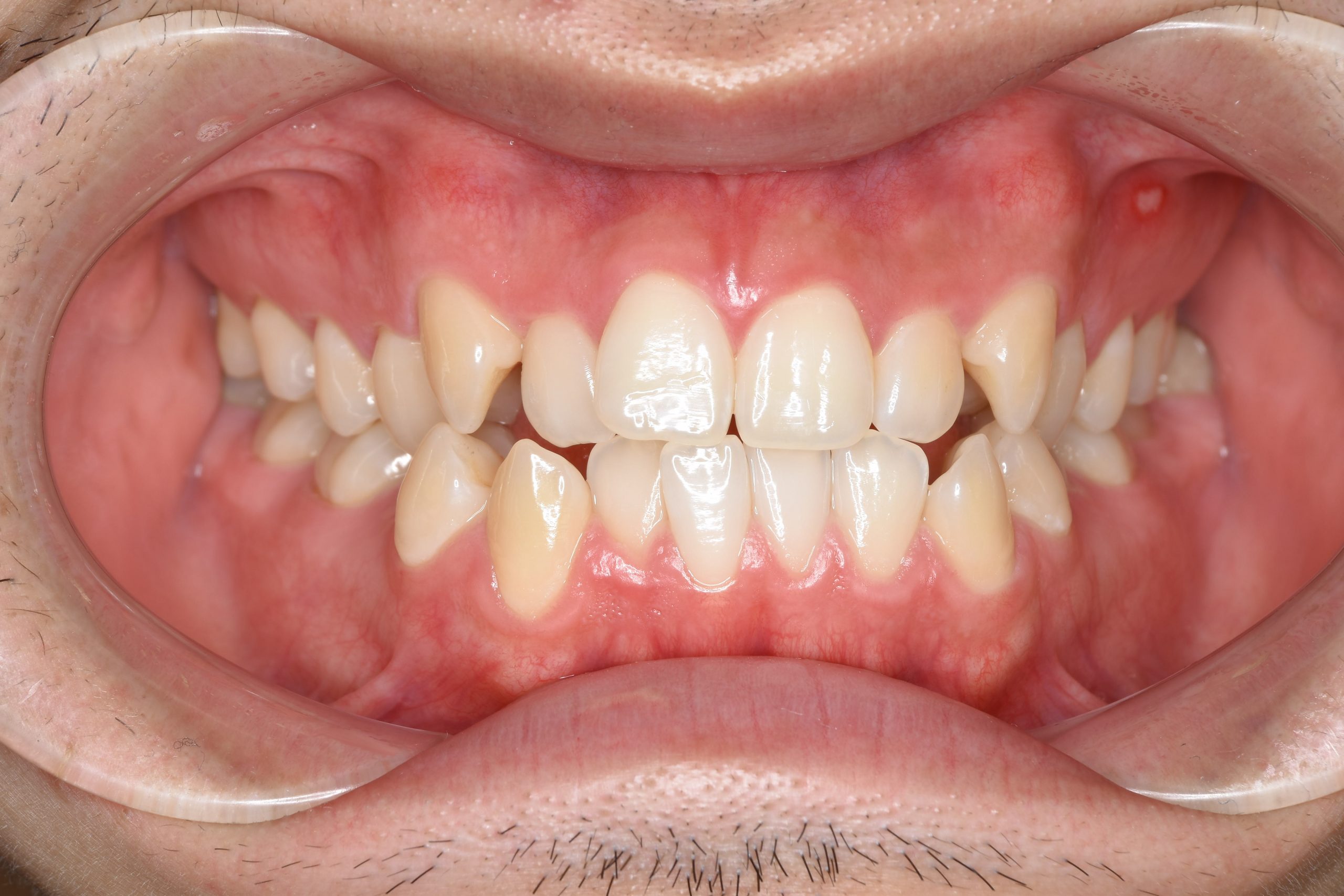 全顎ワイヤー矯正　症例_495