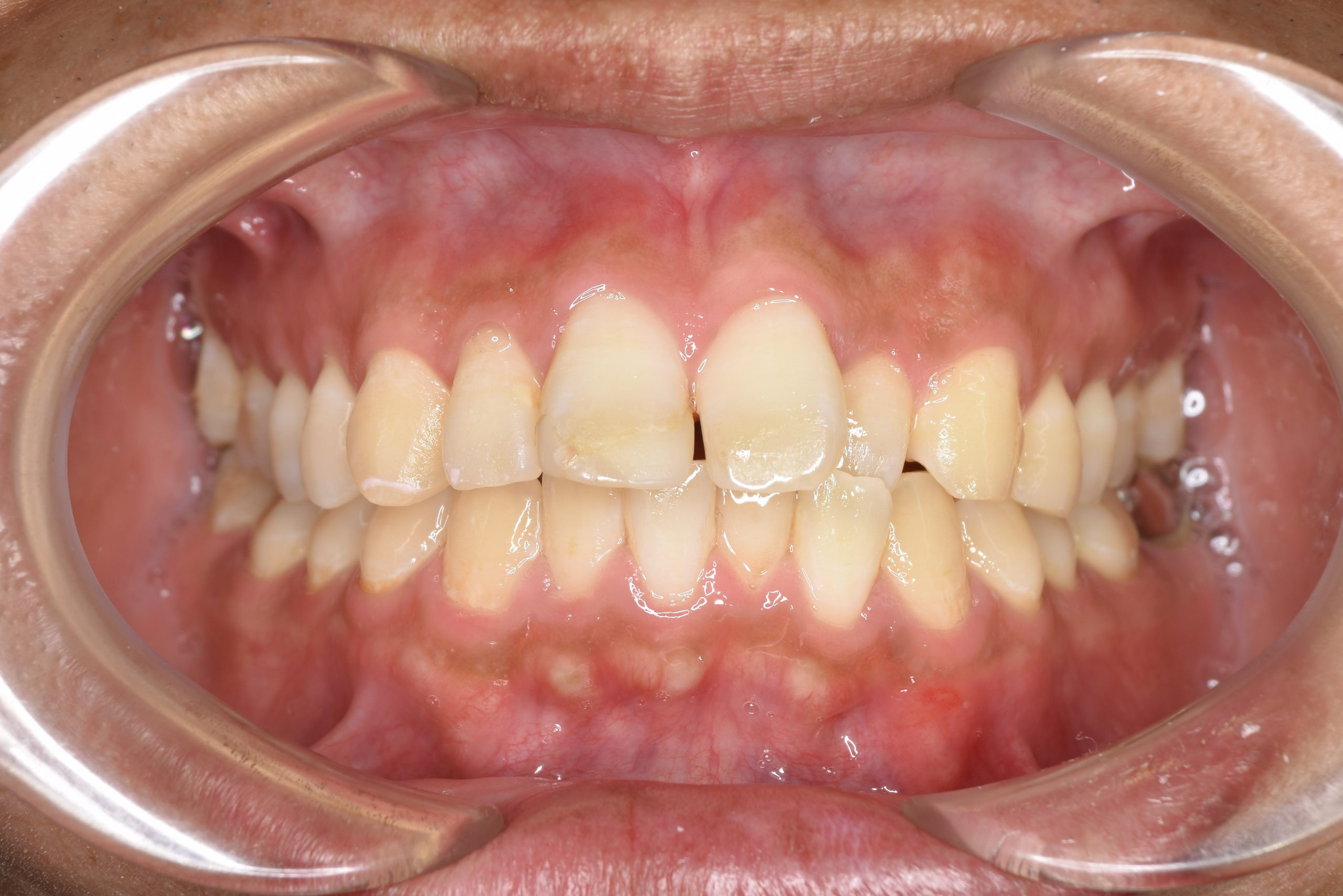 全顎ワイヤー矯正　症例_510