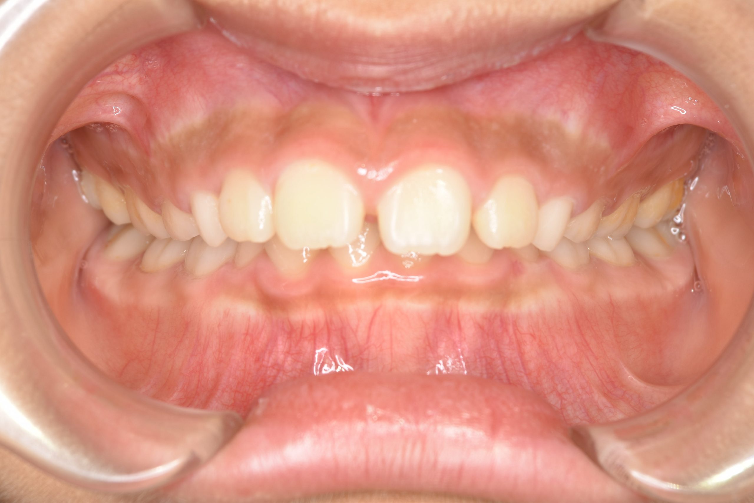 全顎ワイヤー矯正　症例_547