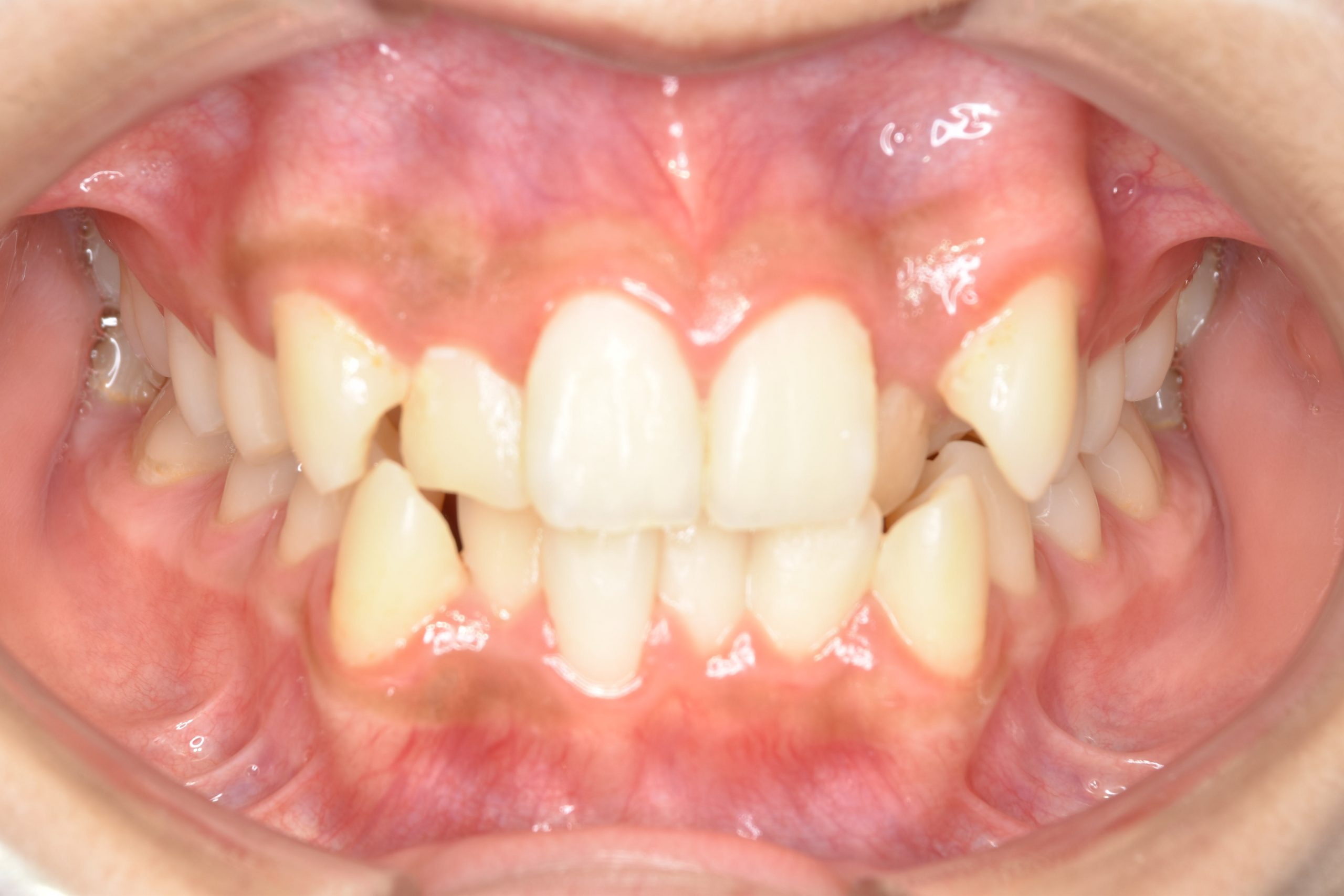 全顎ワイヤー矯正　症例_551