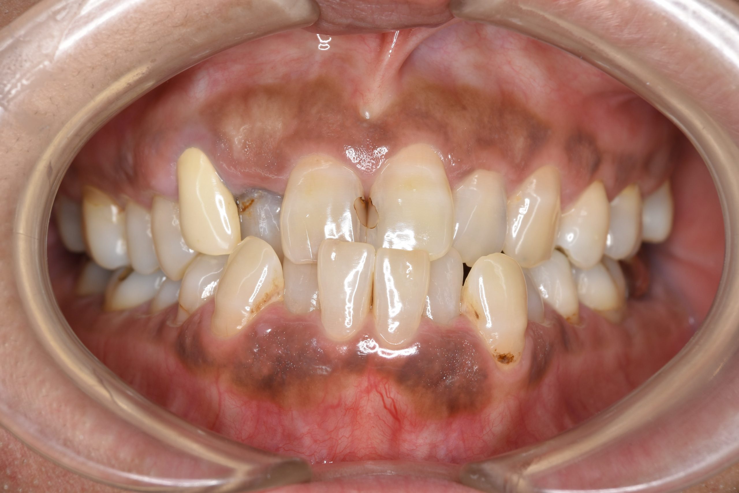 全顎ワイヤー矯正　症例_588