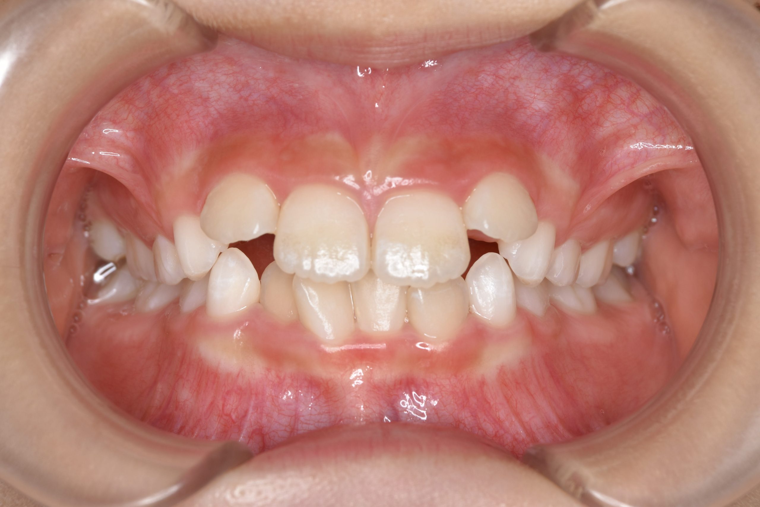 全顎ワイヤー矯正　症例_610