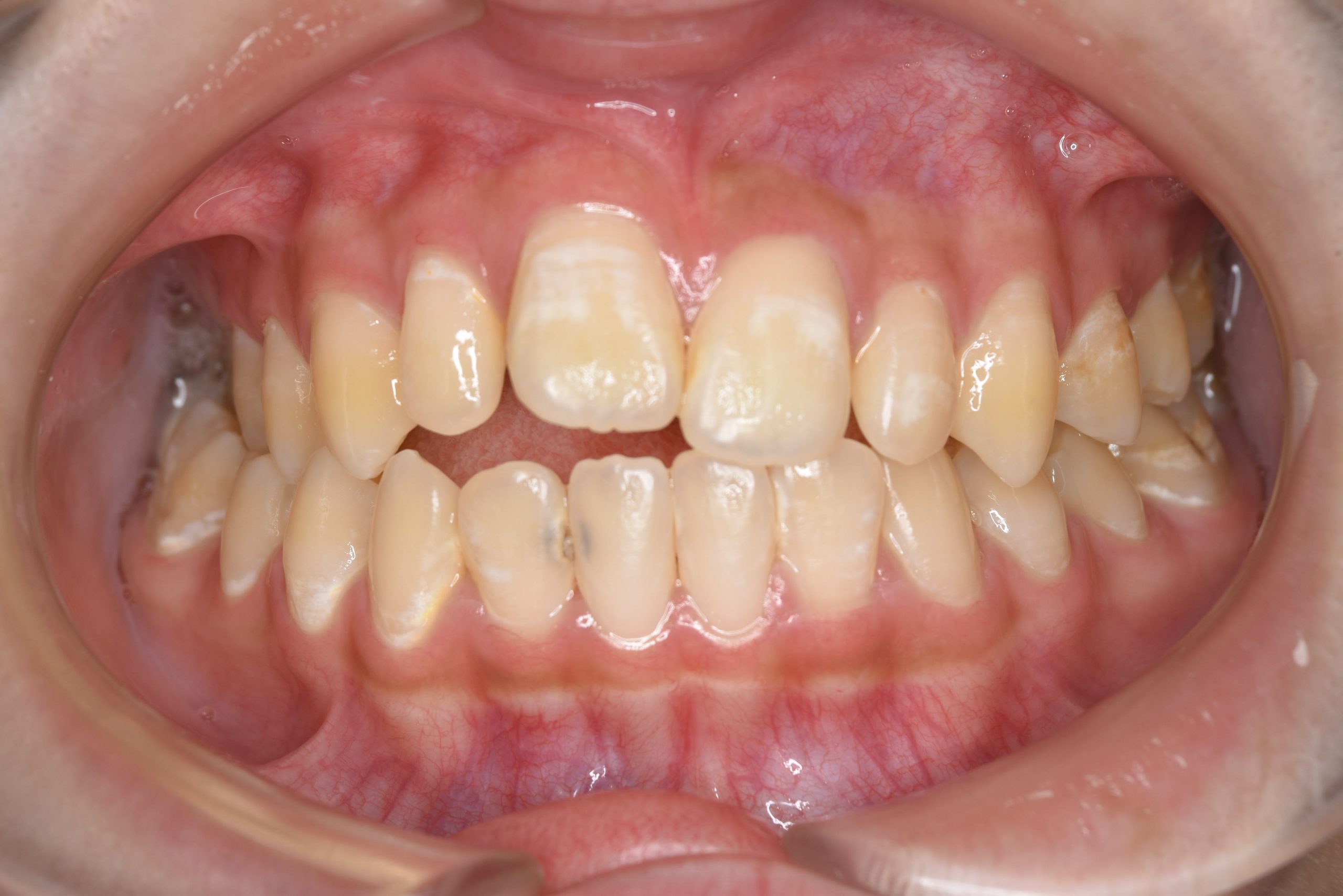 全顎ワイヤー矯正　症例_640