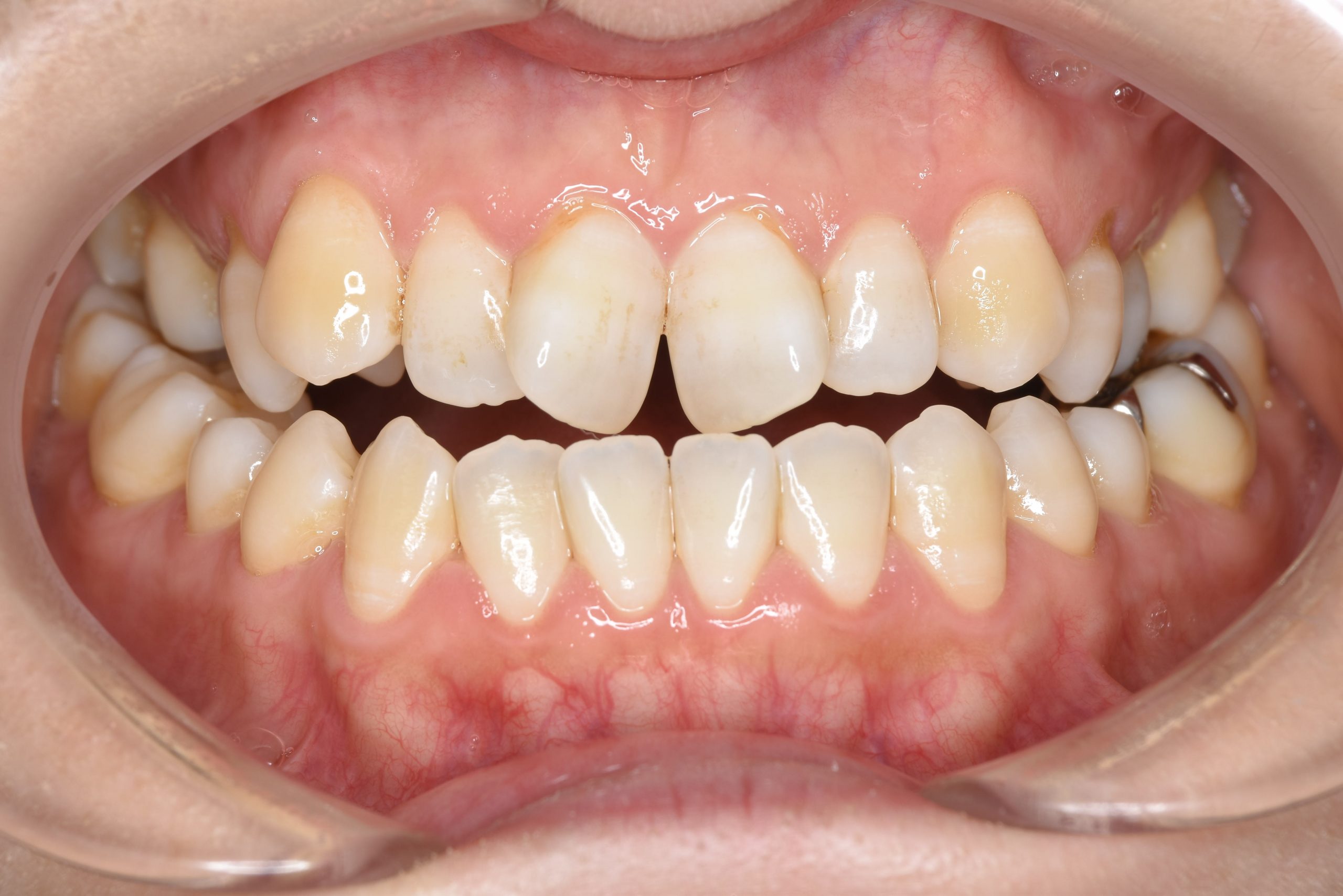 全顎ワイヤー矯正　症例_138