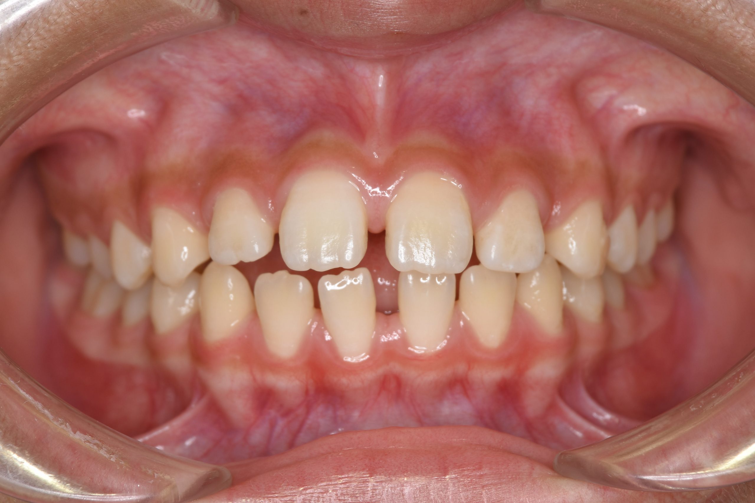 全顎ワイヤー矯正　症例_681