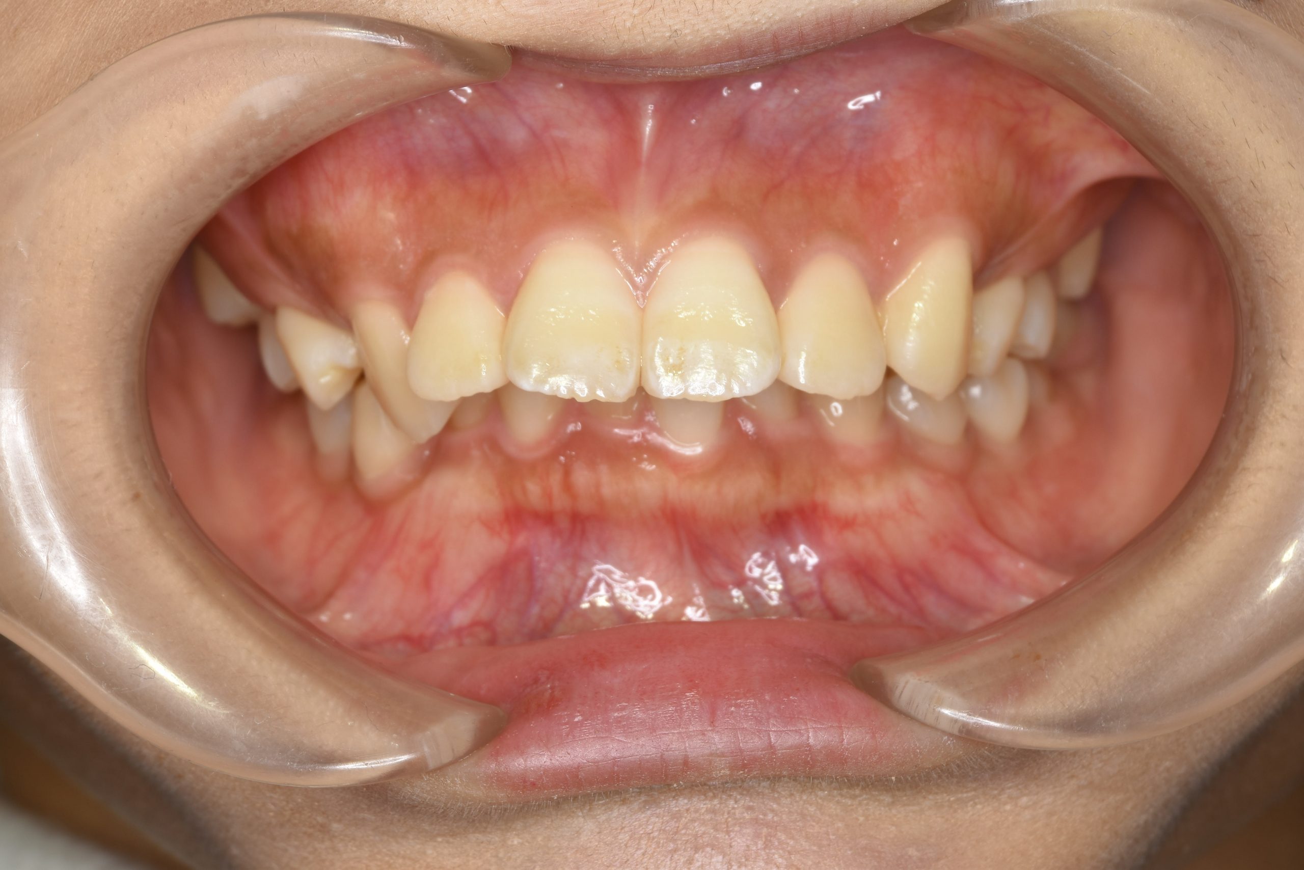 全顎ワイヤー矯正　症例_793