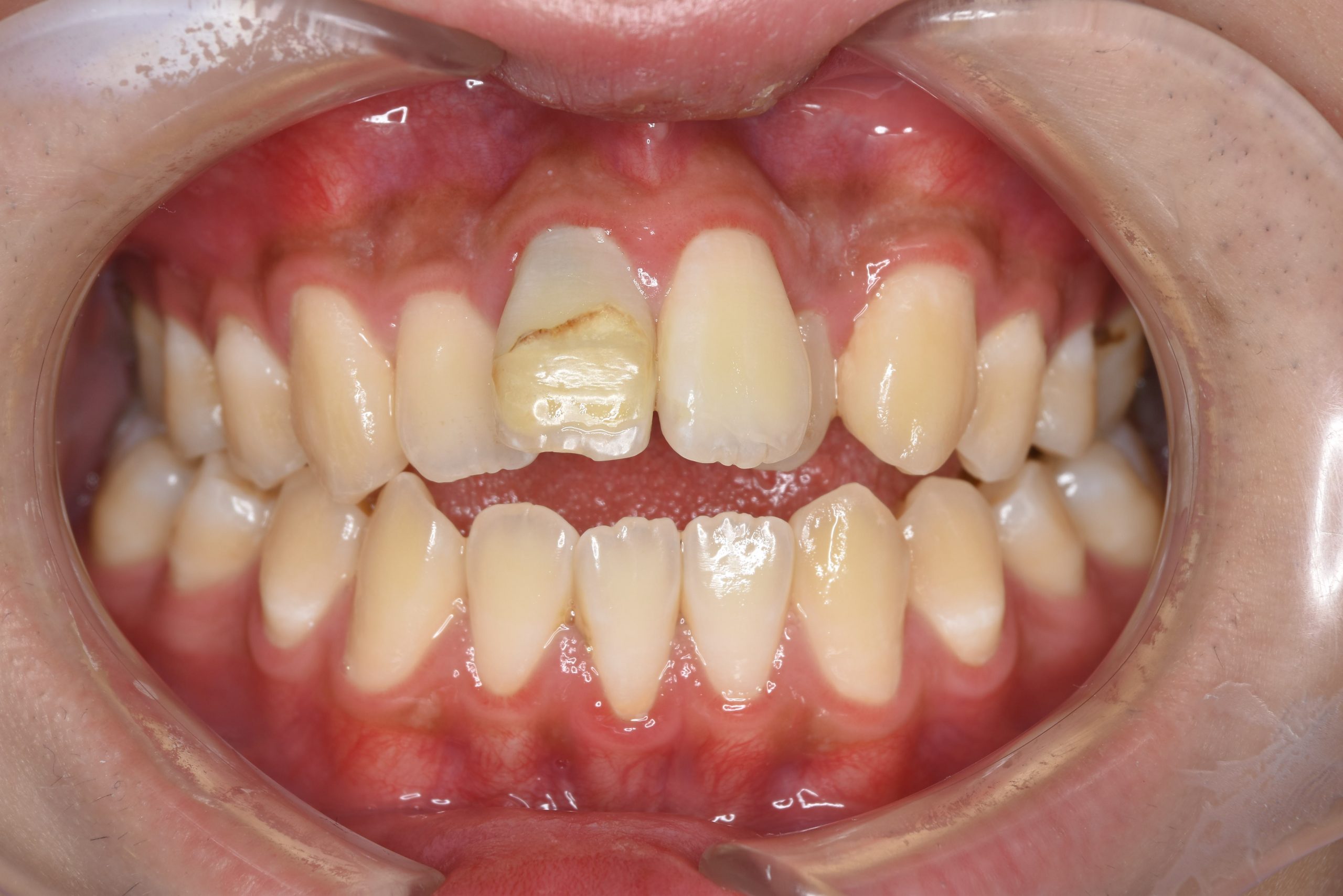 全顎ワイヤー矯正　症例_798