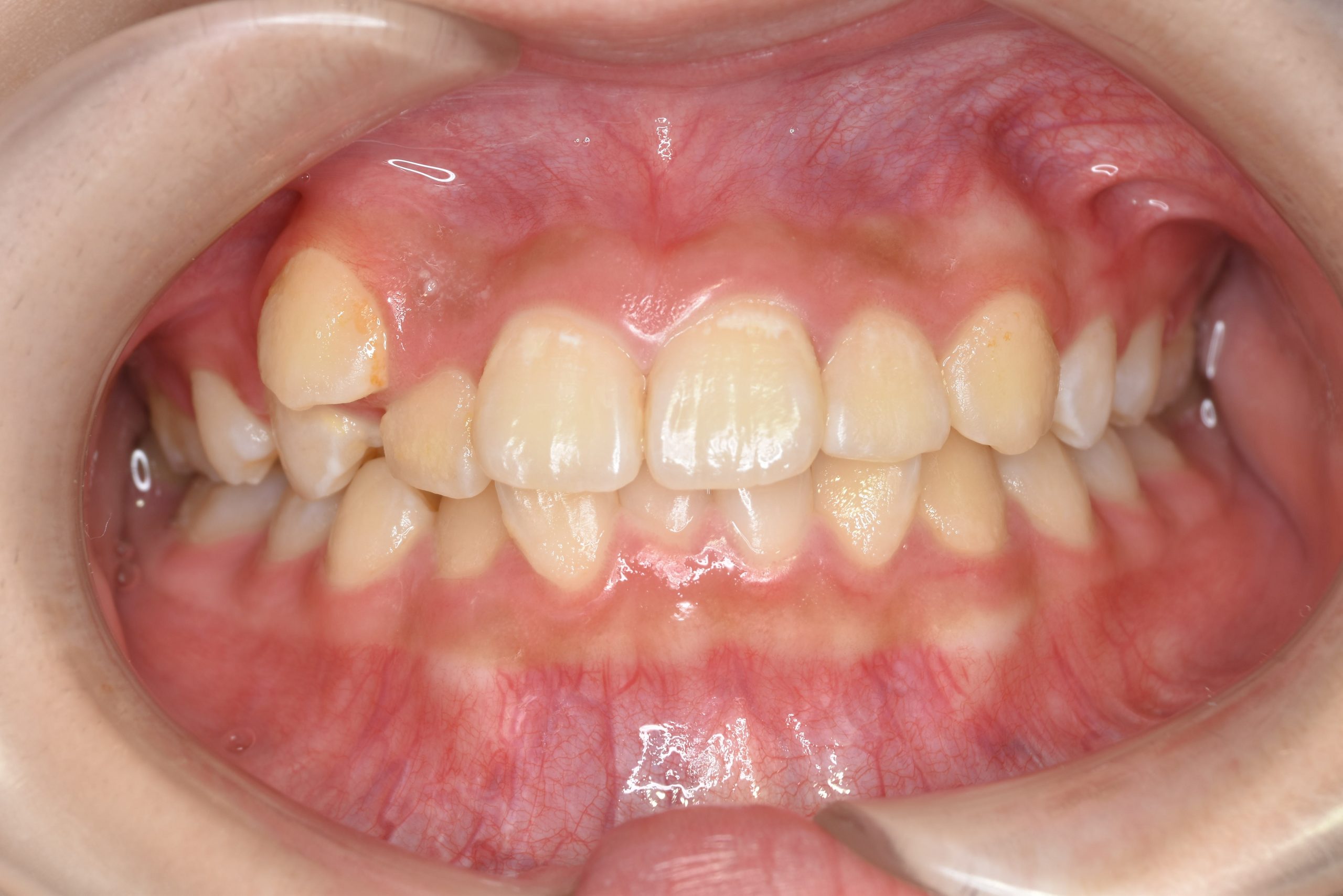 全顎ワイヤー矯正　症例_805