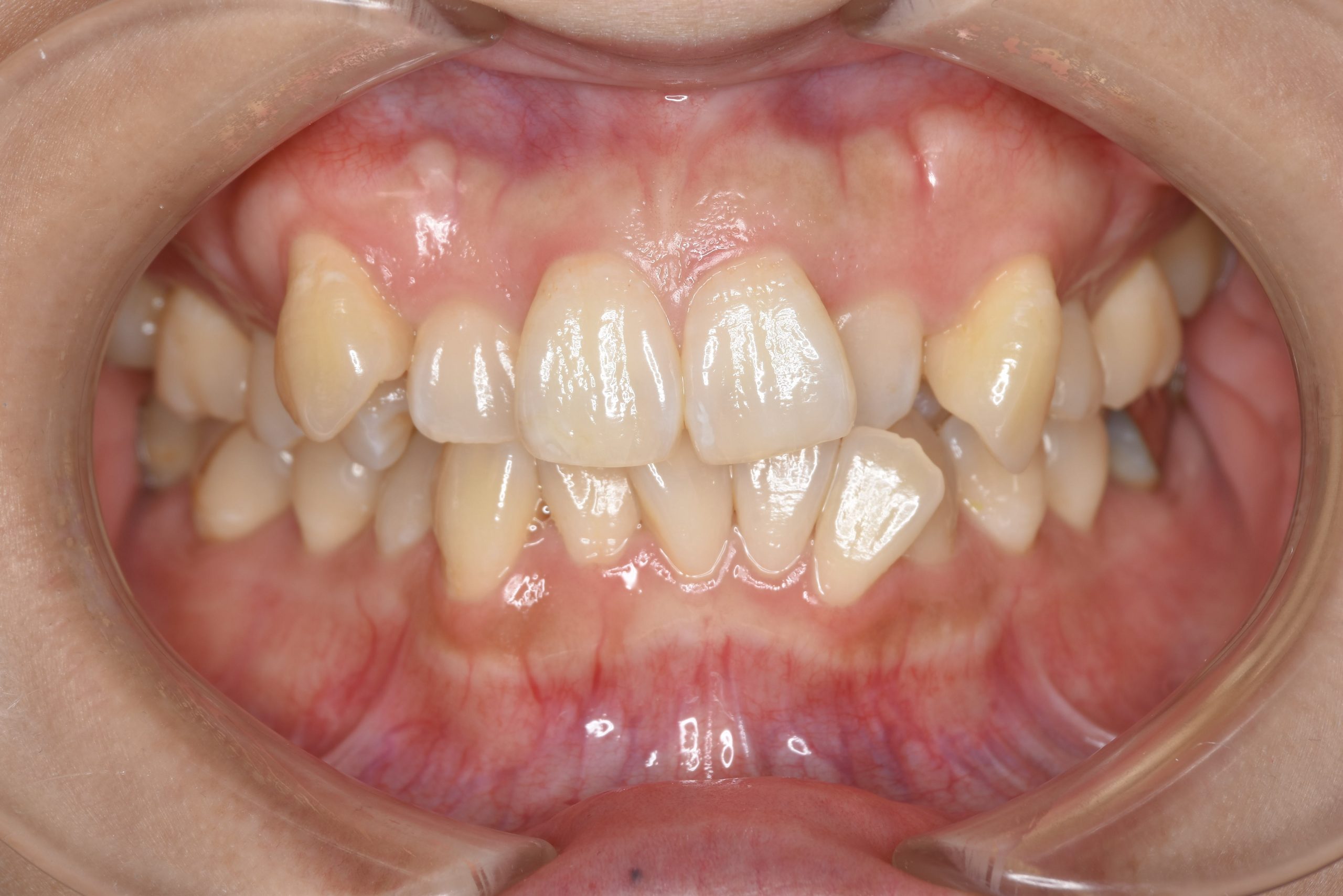 全顎ワイヤー矯正　症例_814
