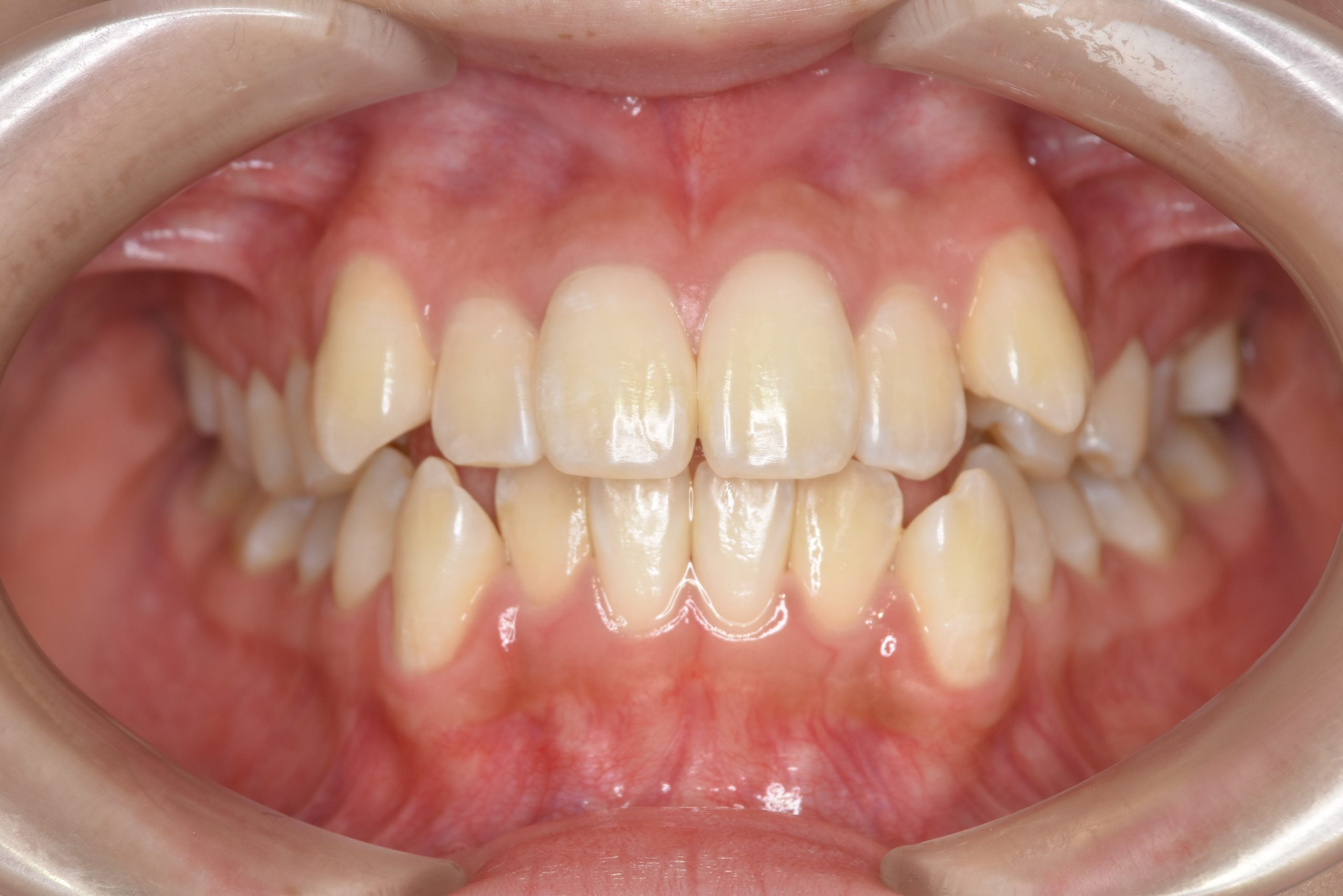 全顎ワイヤー矯正　症例_815