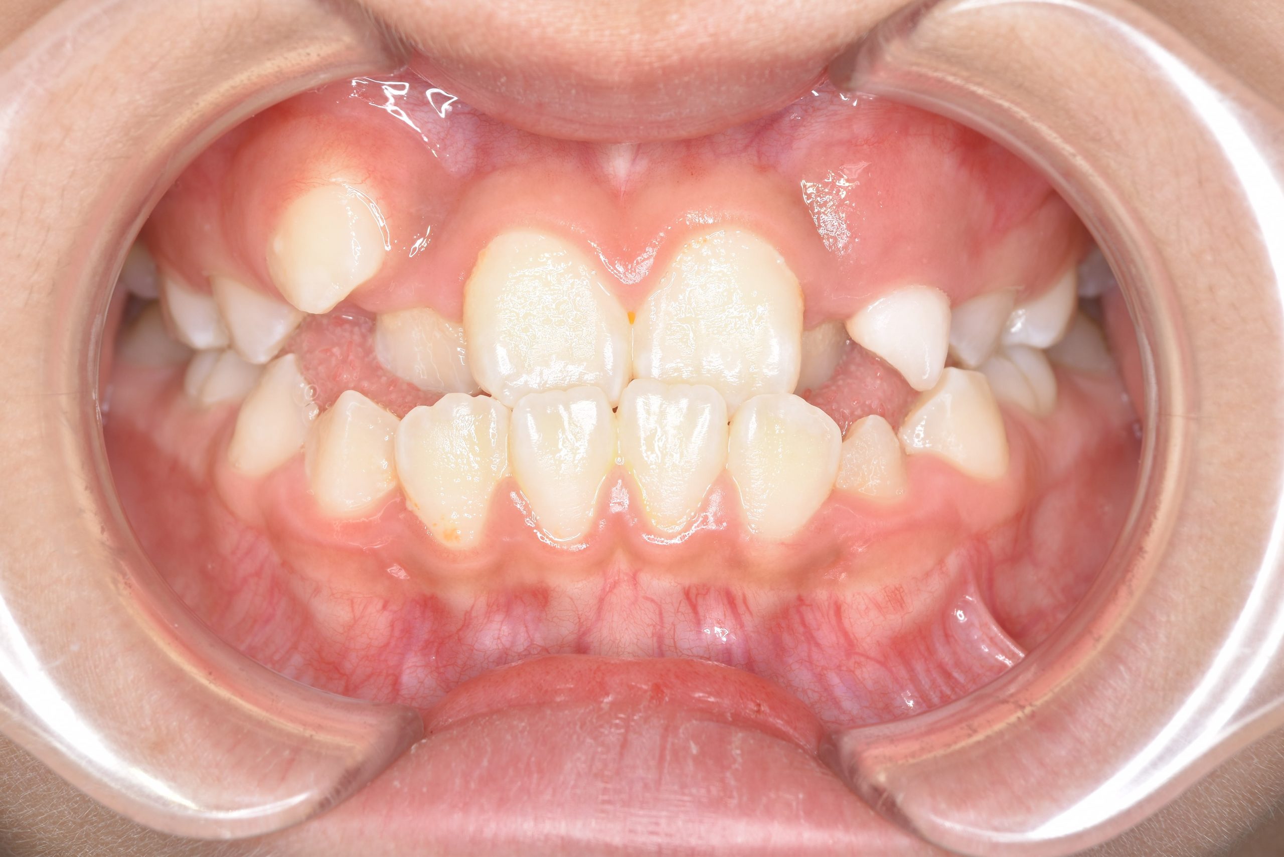 全顎ワイヤー矯正　症例_139