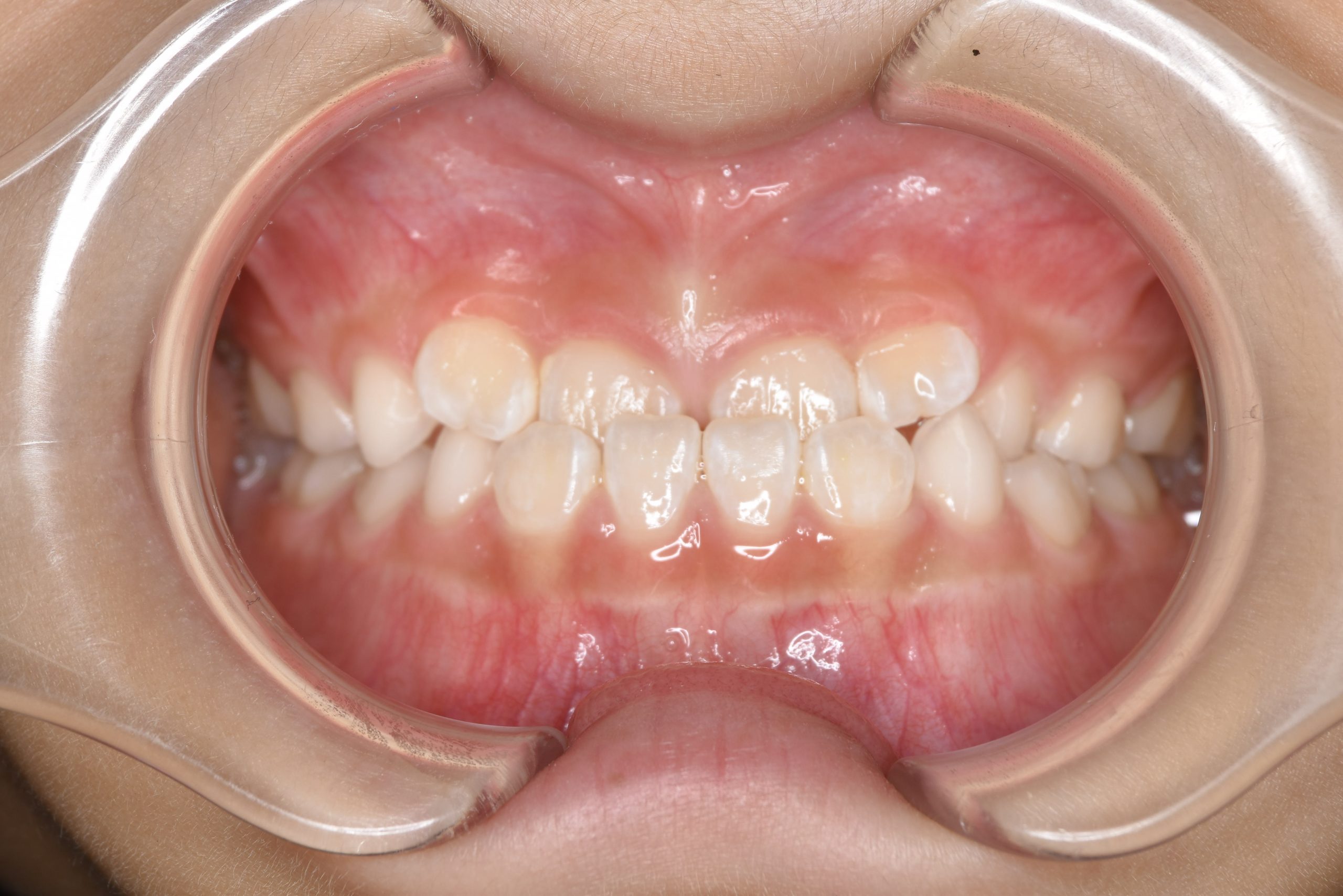 全顎ワイヤー矯正　症例_858