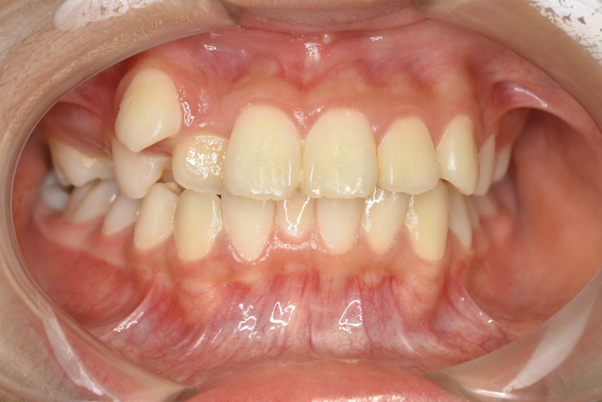 全顎ワイヤー矯正　症例_1324