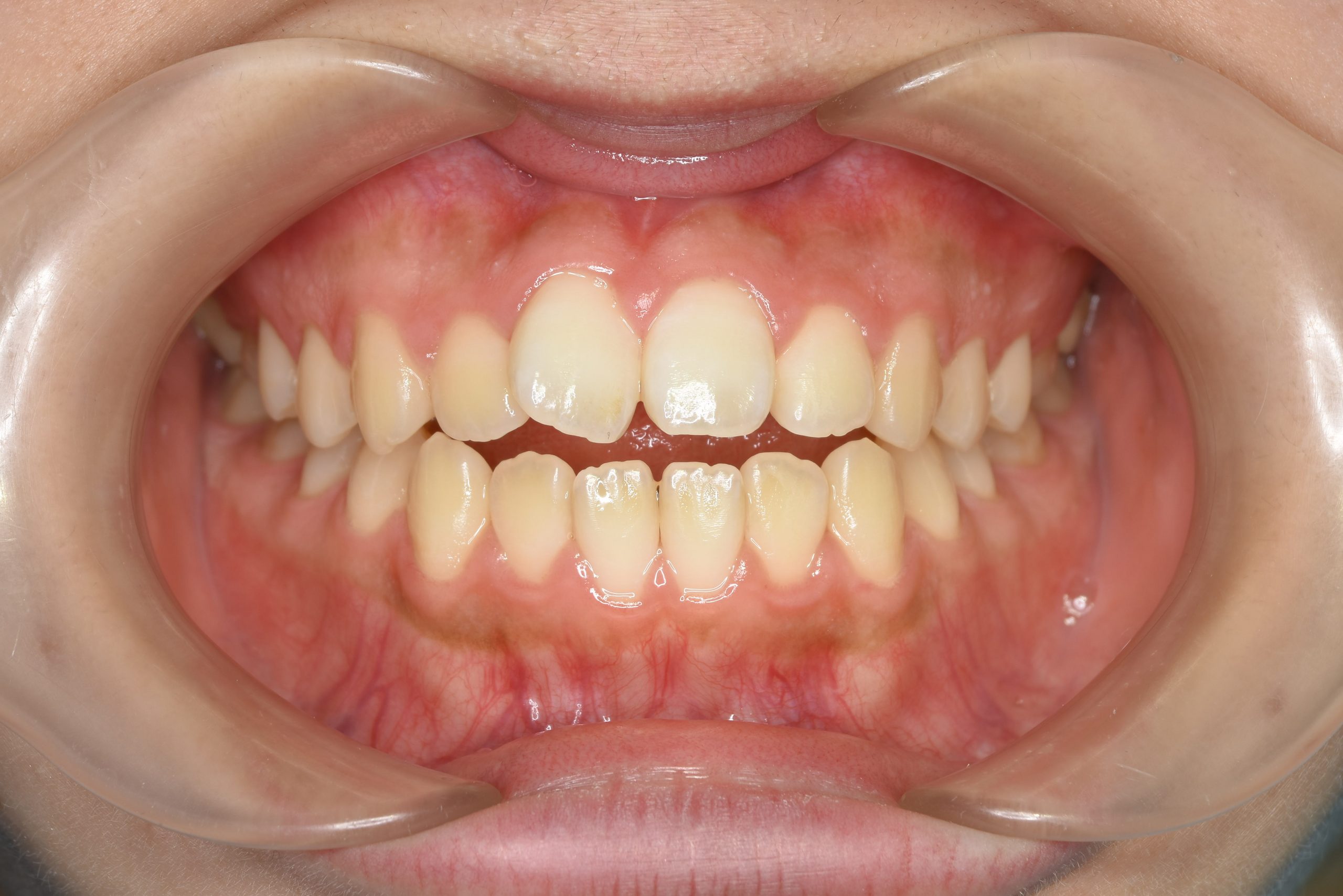 全顎ワイヤー矯正　症例_1409