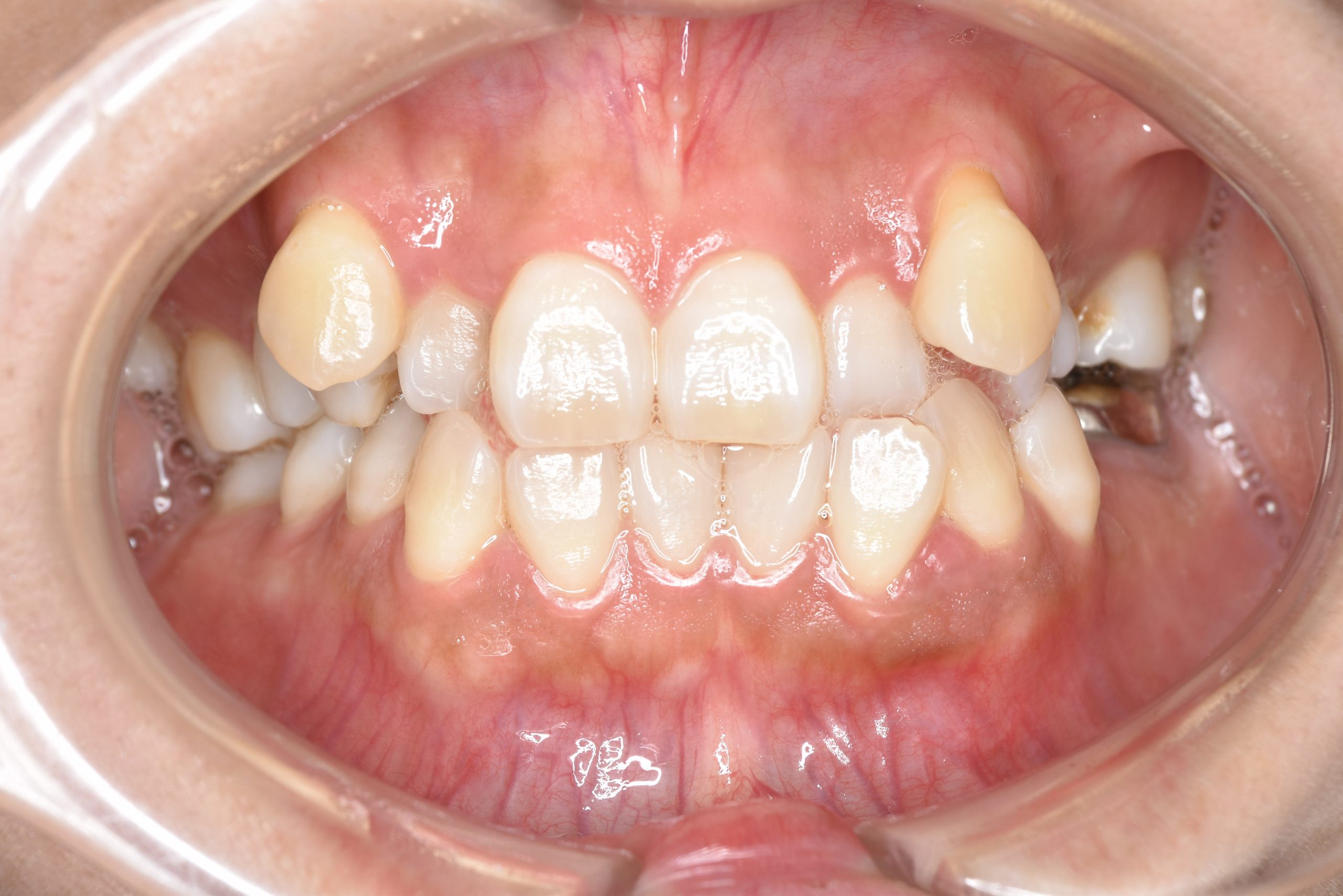 全顎ワイヤー矯正　症例_141