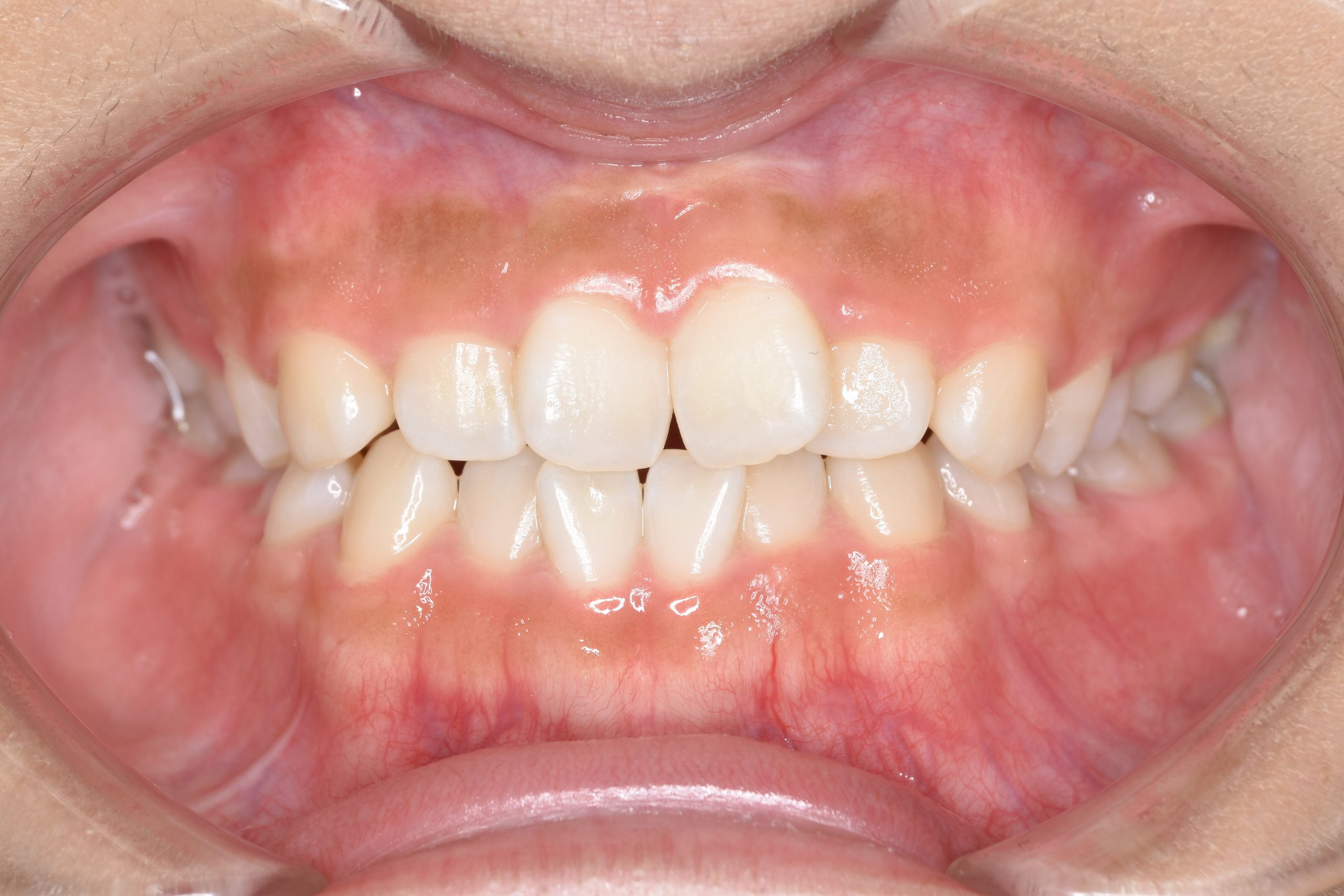 全顎ワイヤー矯正　症例_148