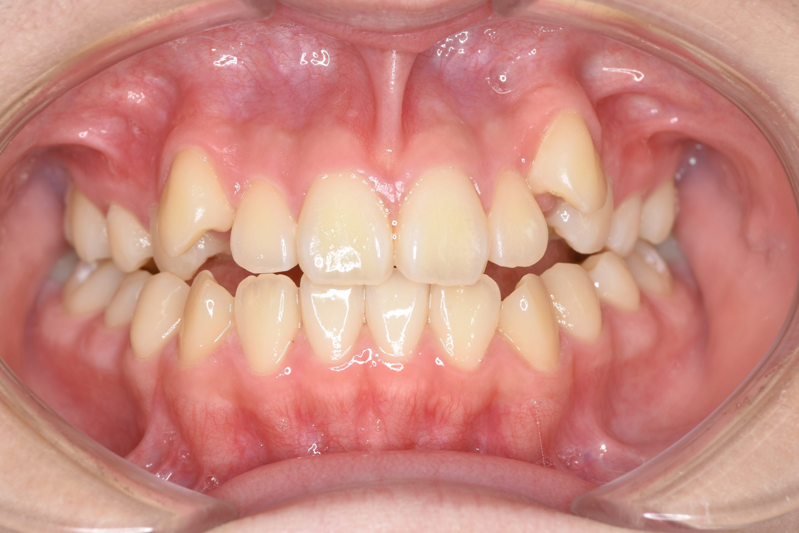 全顎ワイヤー矯正　症例_154