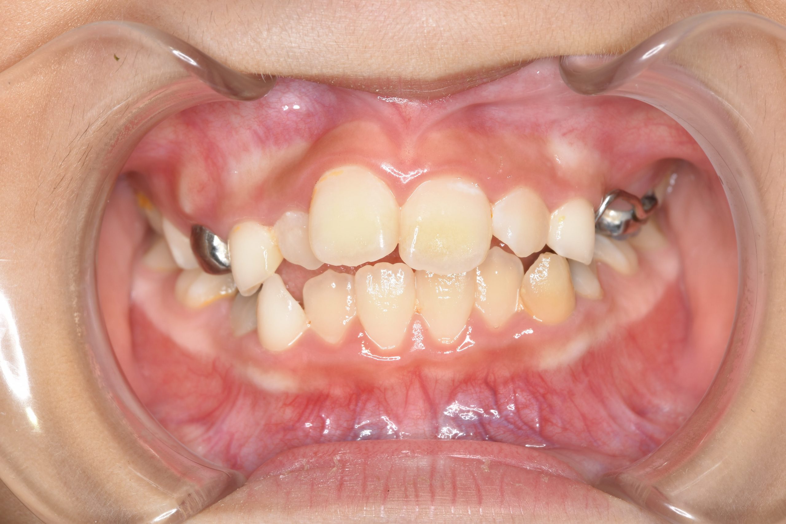 全顎ワイヤー矯正　症例_169