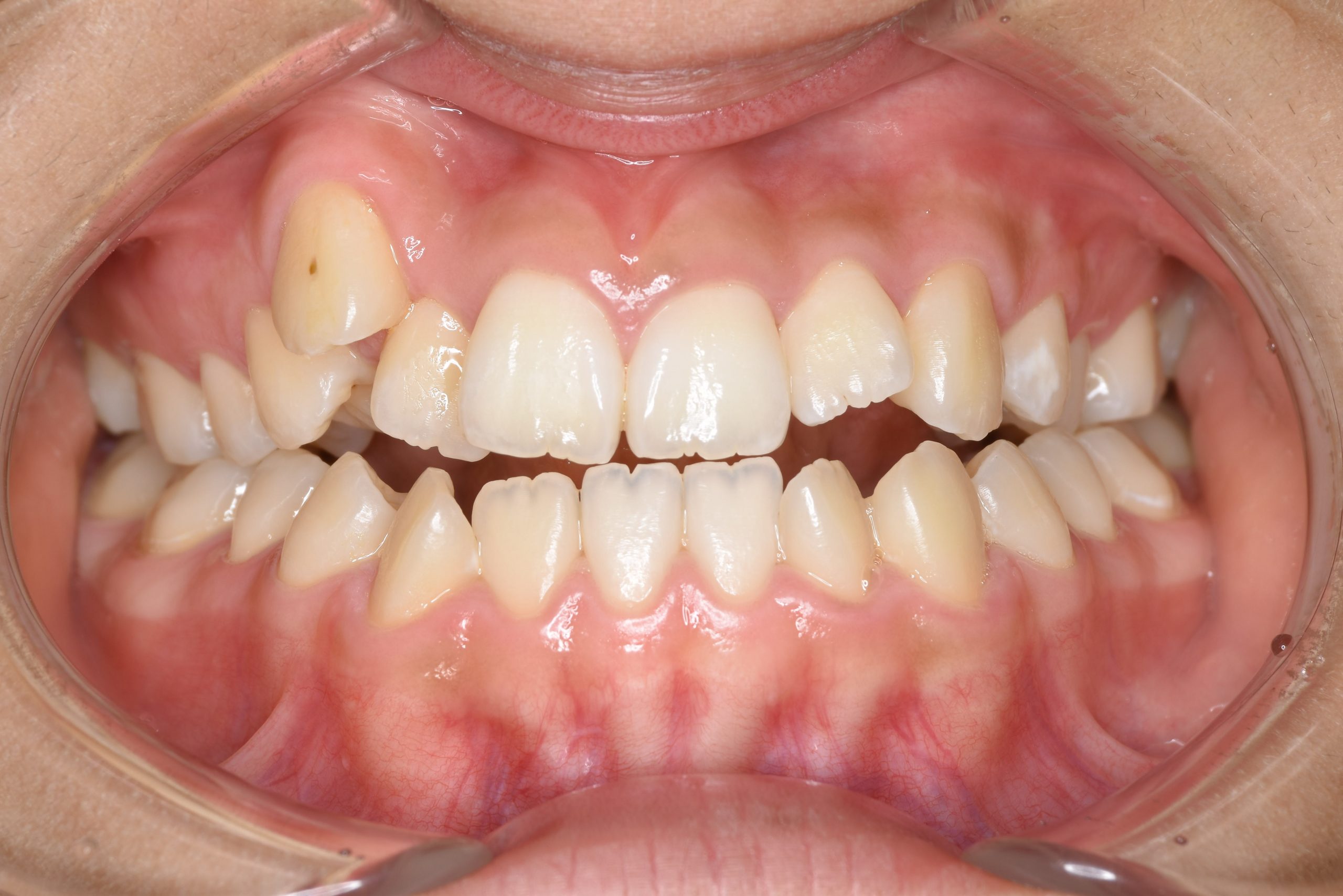 全顎ワイヤー矯正　症例_29