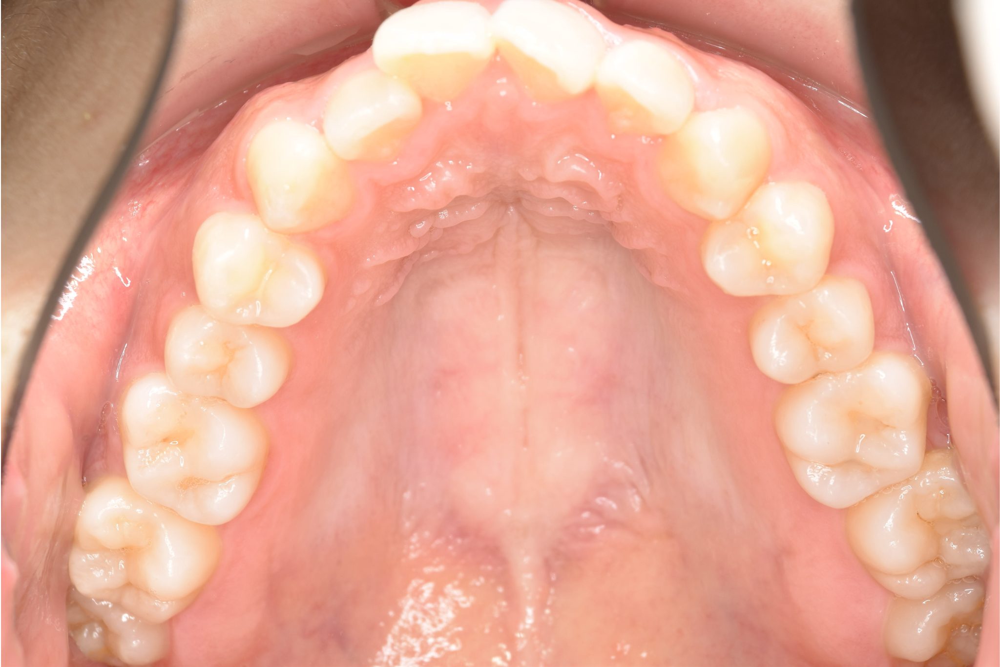 全顎ワイヤー矯正　症例_315