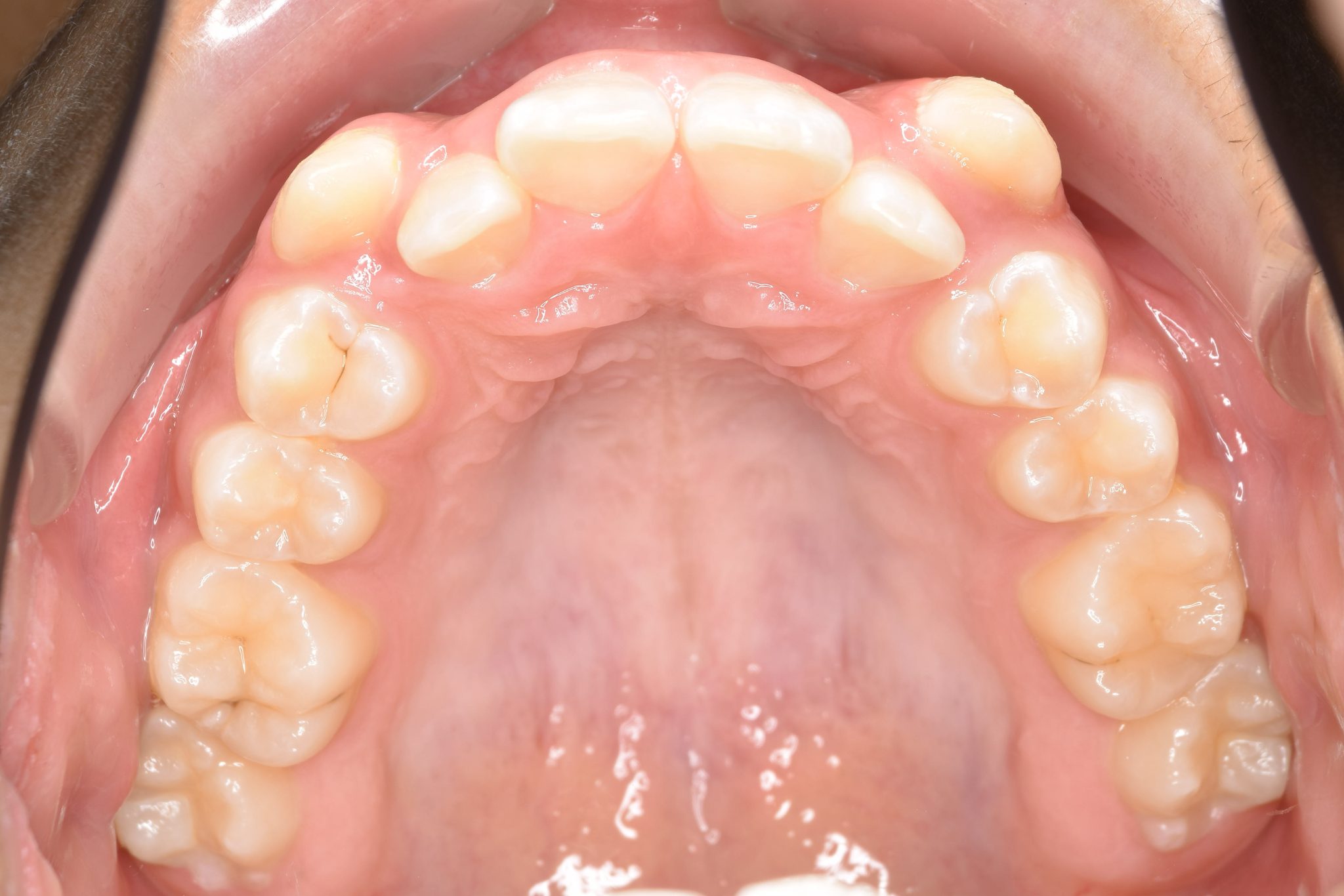 全顎ワイヤー矯正　症例_320