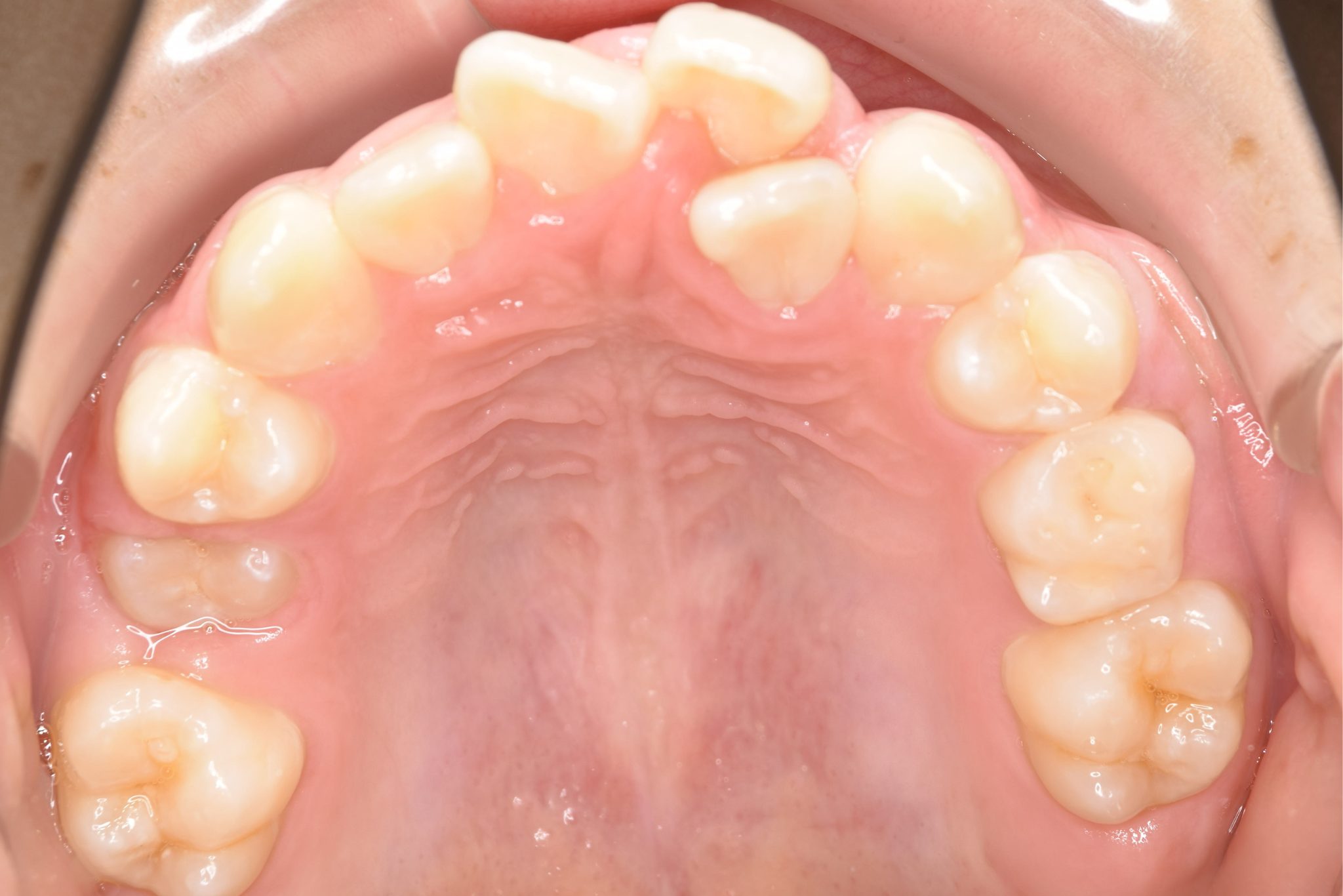 全顎ワイヤー矯正　症例_323