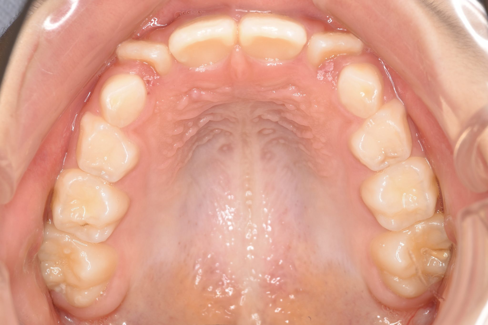 全顎ワイヤー矯正　症例_347