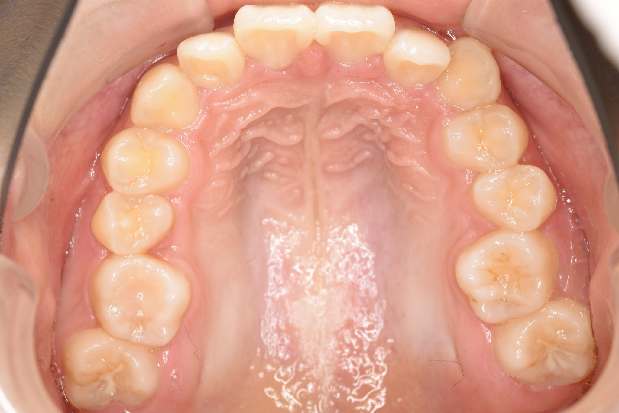 全顎ワイヤー矯正　症例_349