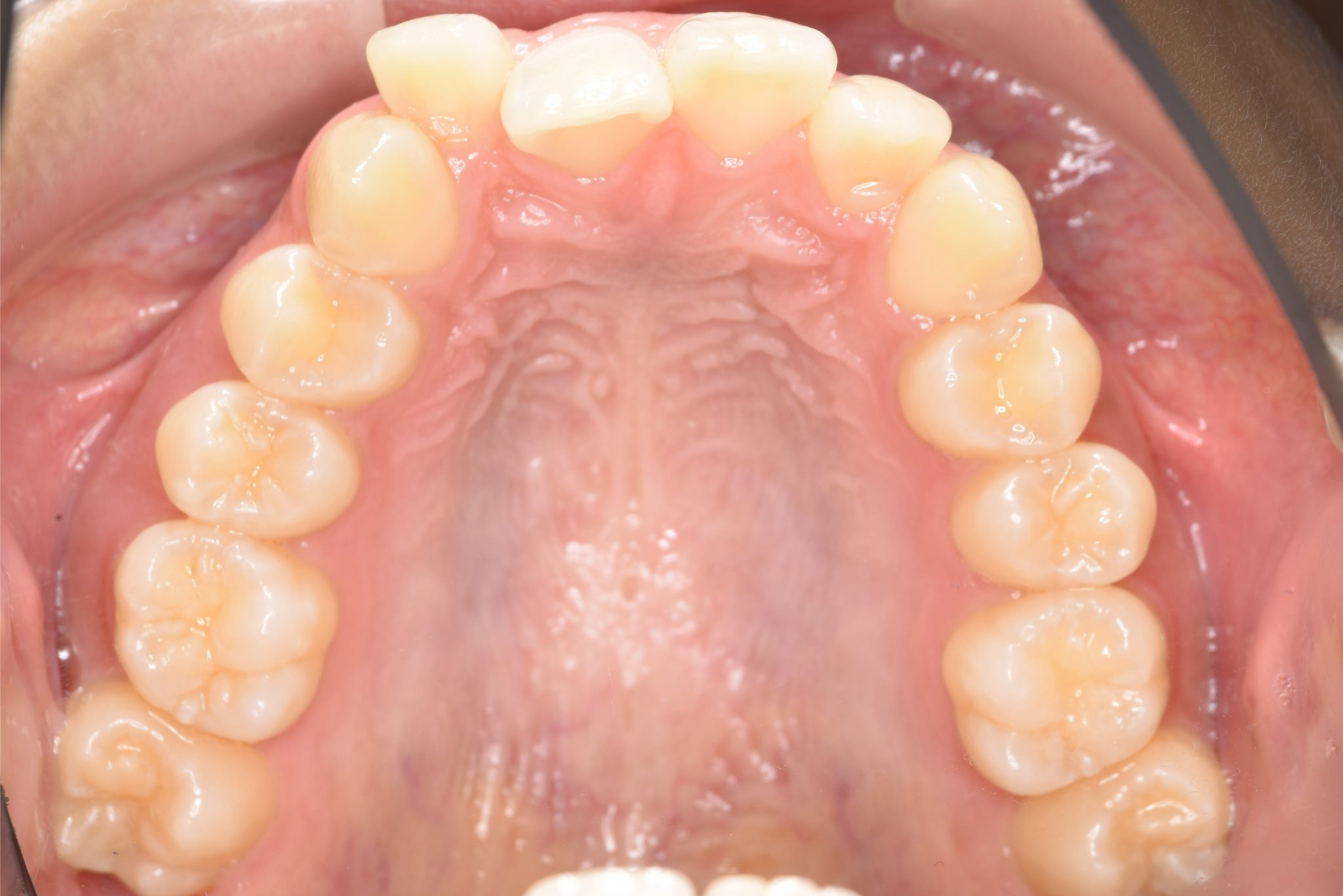 全顎ワイヤー矯正　症例_418