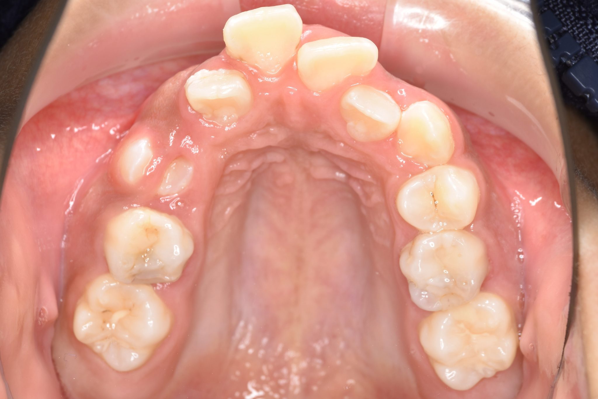 全顎ワイヤー矯正　症例_474