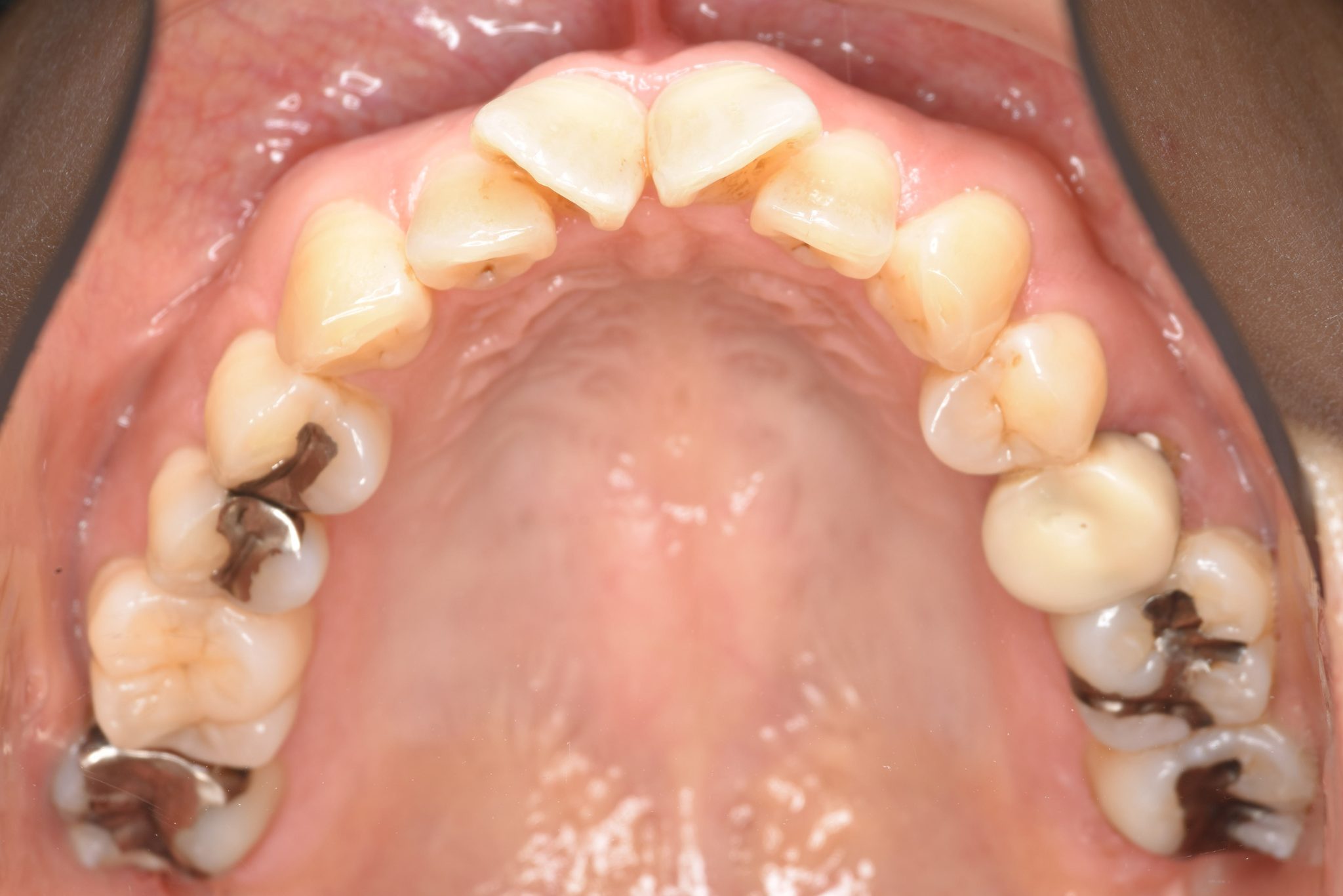 全顎ワイヤー矯正　症例_479