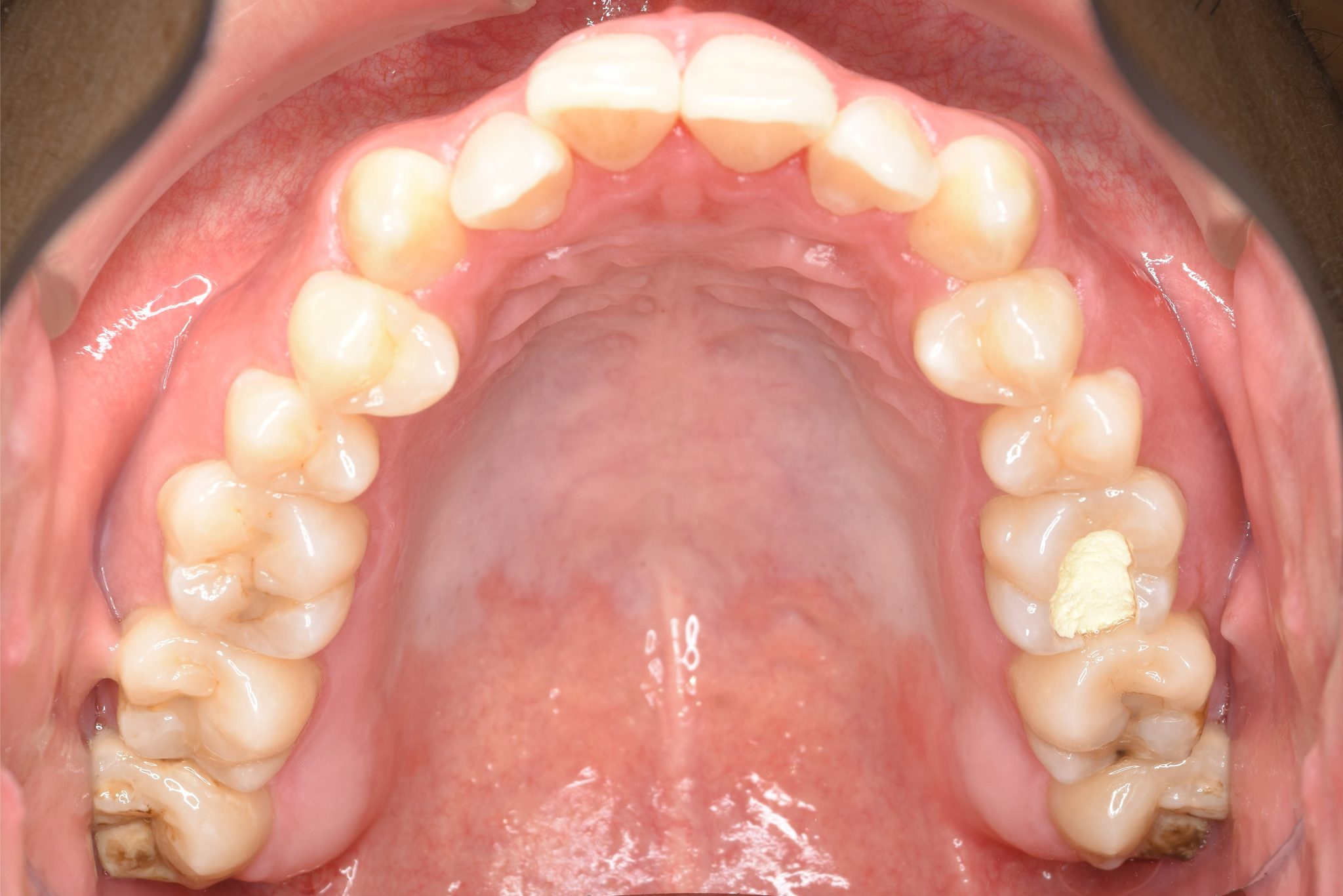 全顎ワイヤー矯正　症例_495