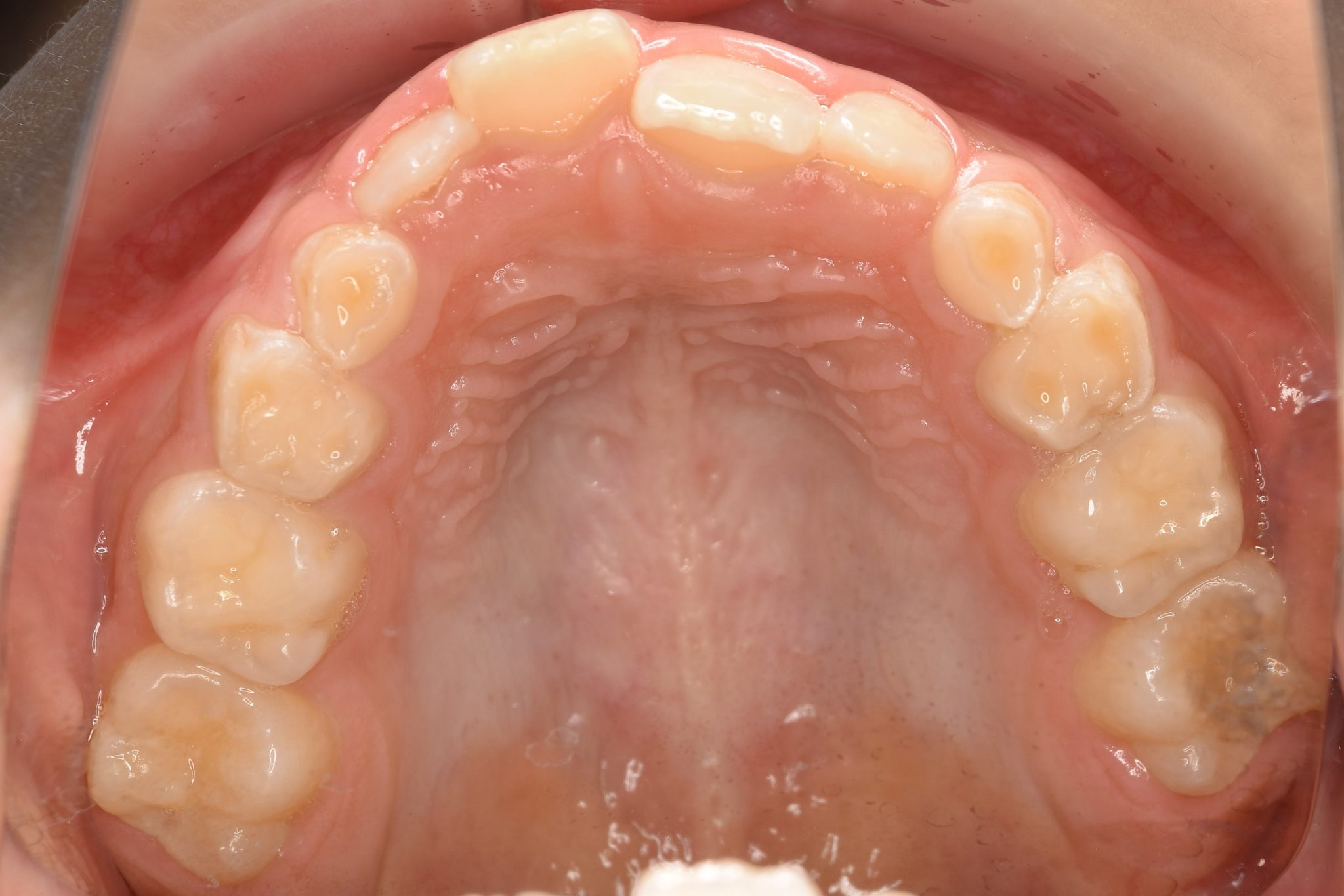 全顎ワイヤー矯正　症例_108