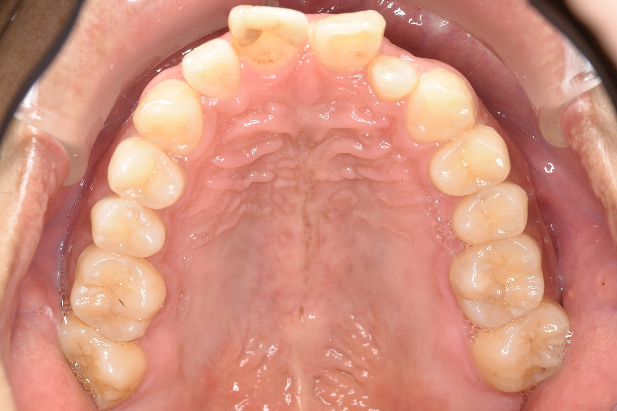 全顎ワイヤー矯正　症例_510