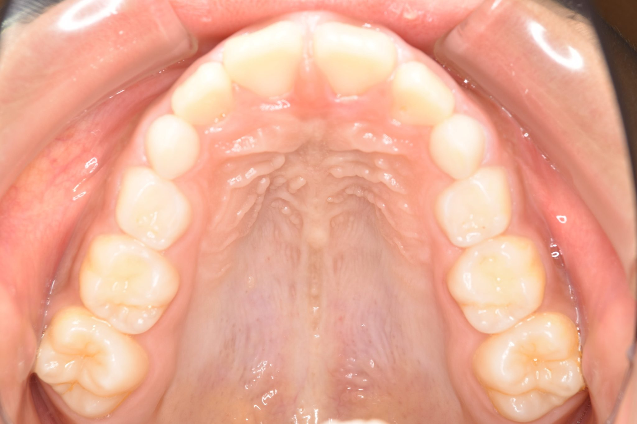 全顎ワイヤー矯正　症例_547