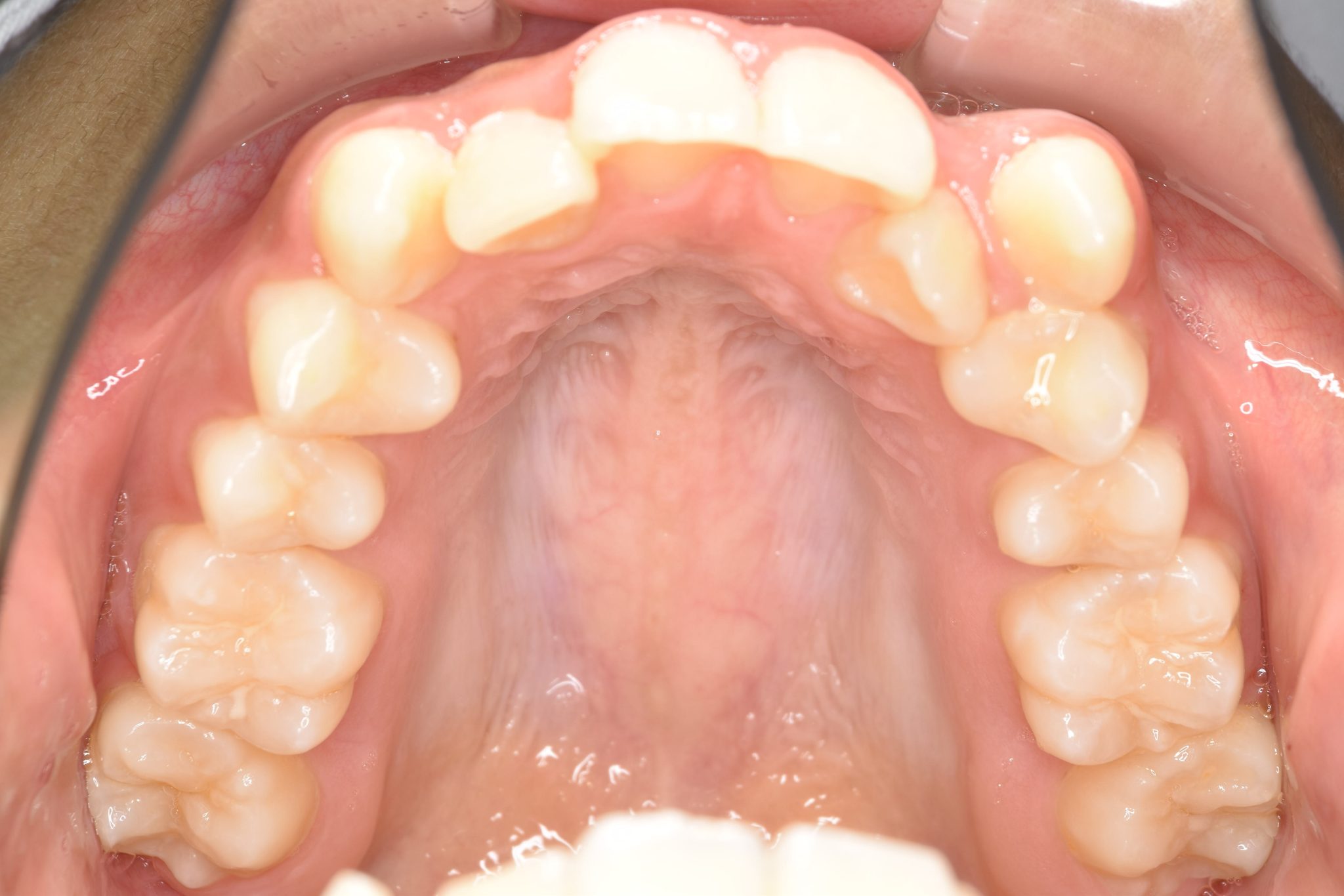 全顎ワイヤー矯正　症例_551