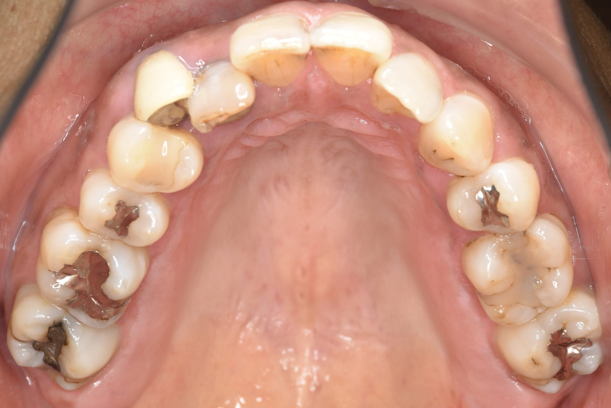 全顎ワイヤー矯正　症例_588