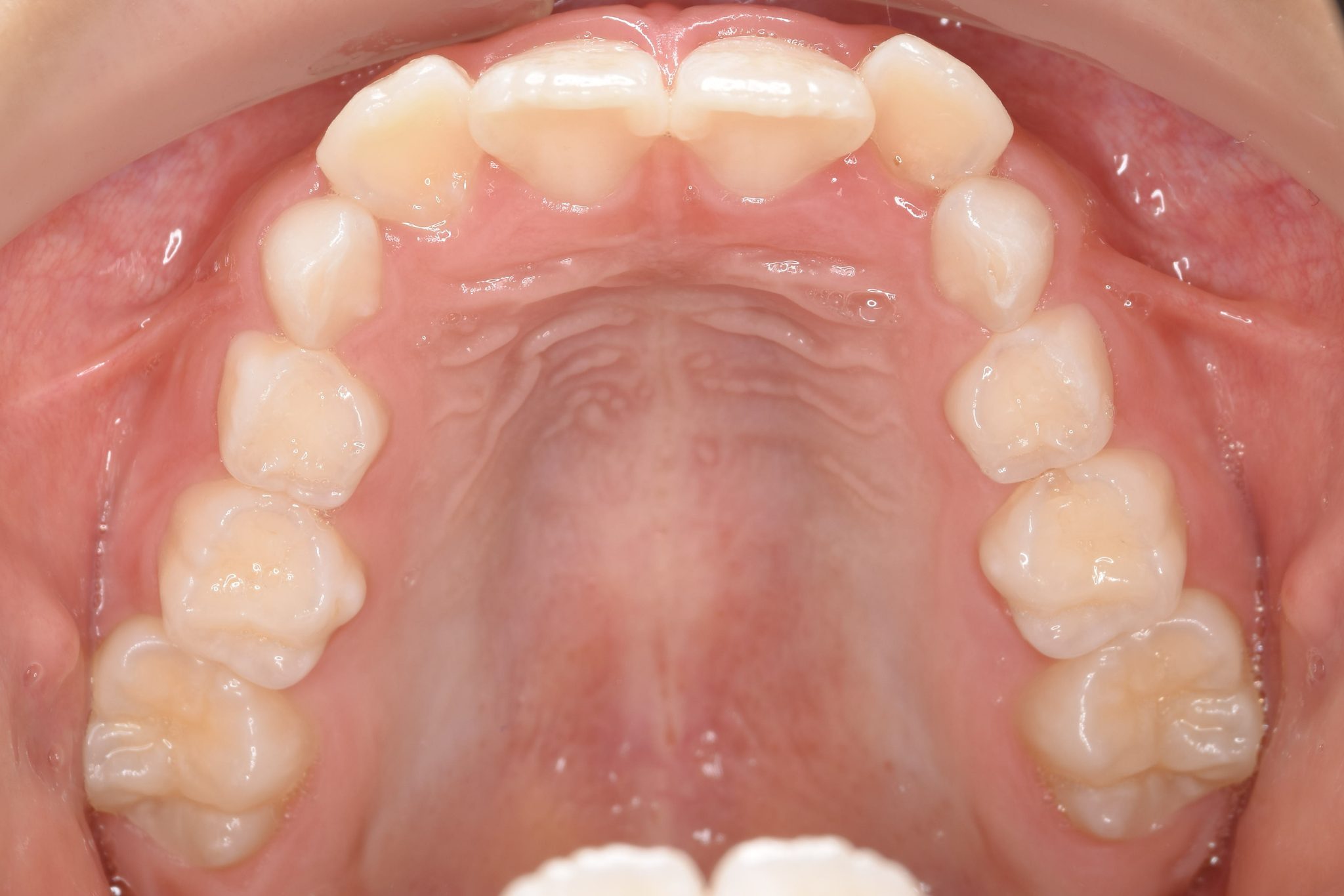 全顎ワイヤー矯正　症例_610
