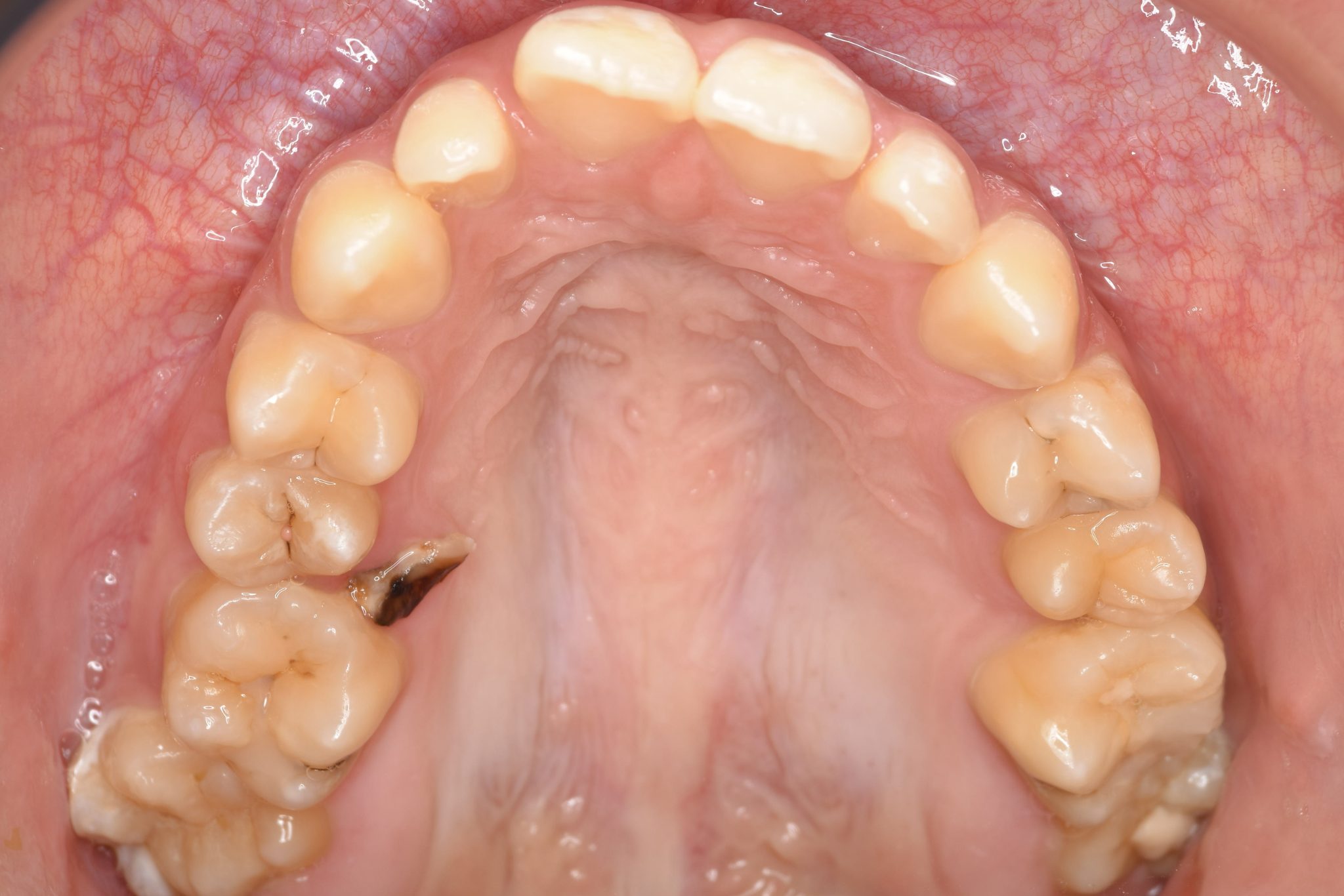 全顎ワイヤー矯正　症例_640