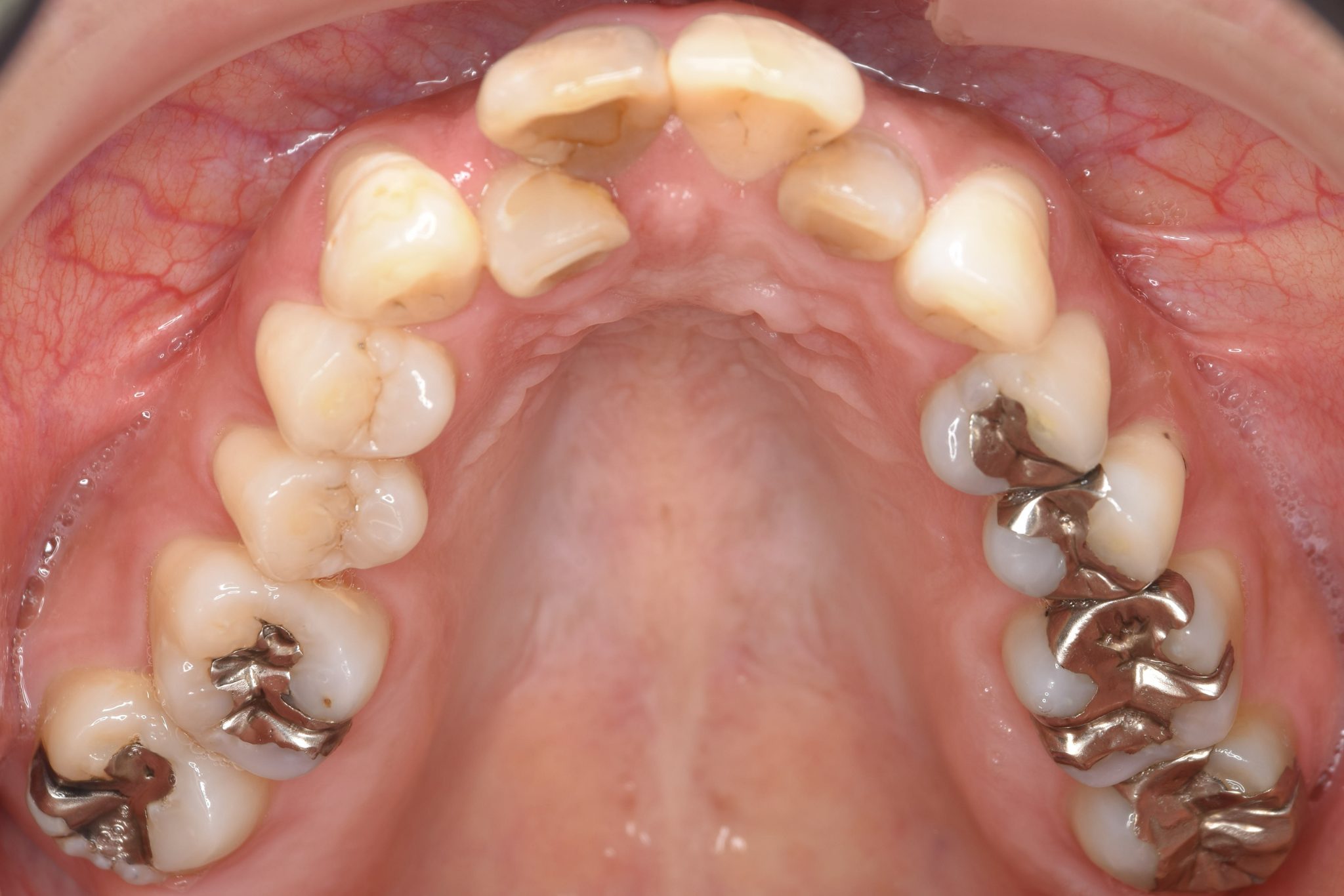 全顎ワイヤー矯正　症例_649