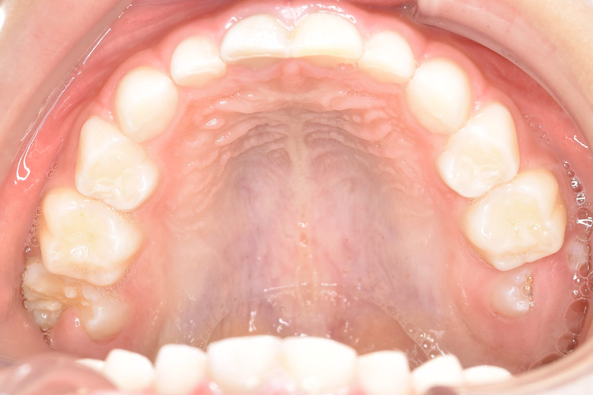 全顎ワイヤー矯正　症例_121