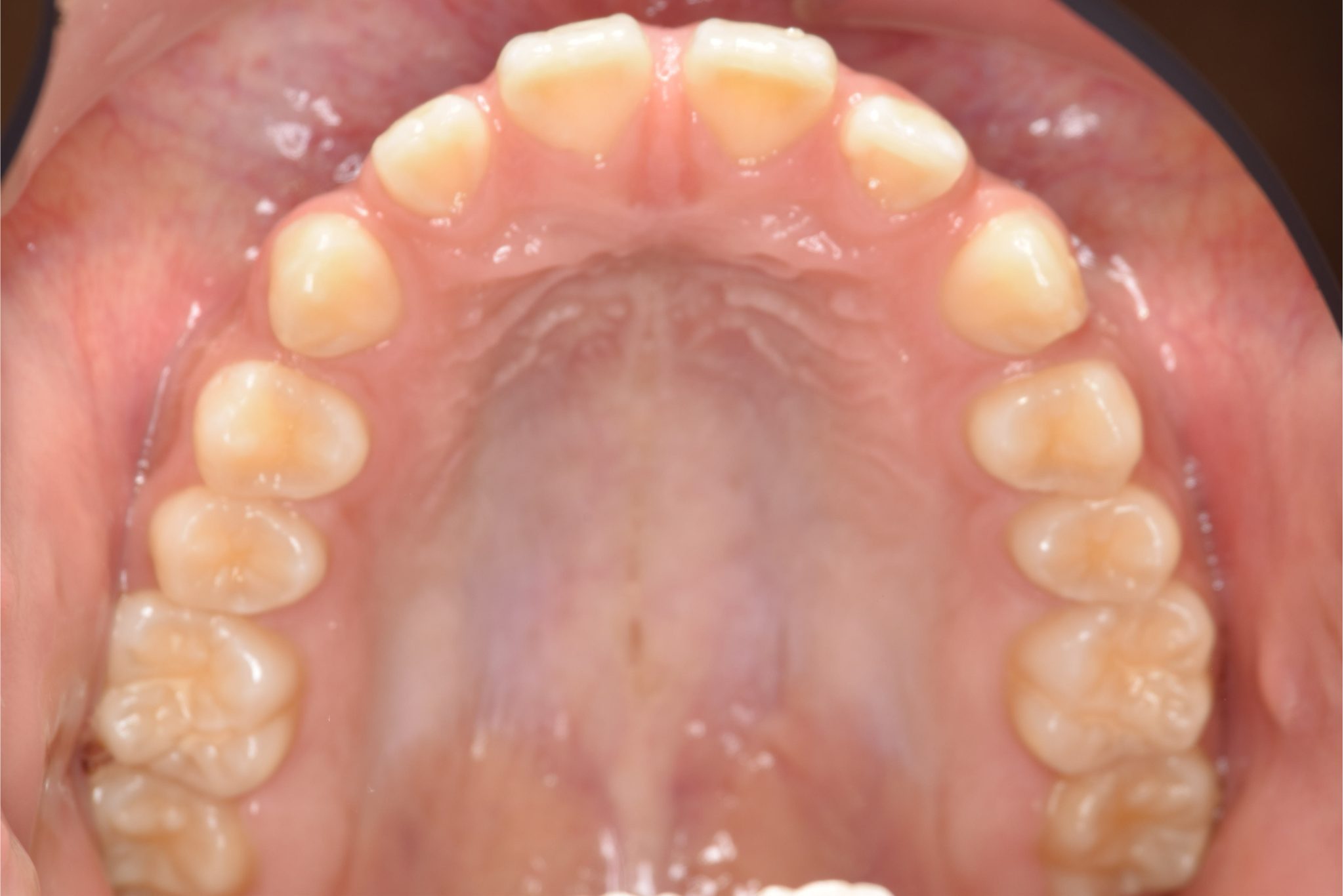 全顎ワイヤー矯正　症例_681